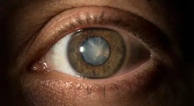 What Does Glaucoma Look Like