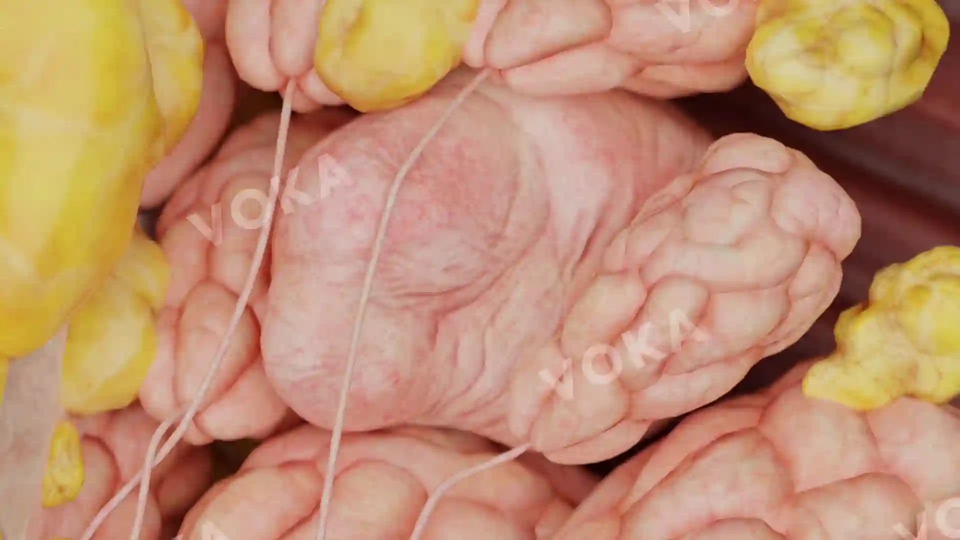 Breast Cyst image