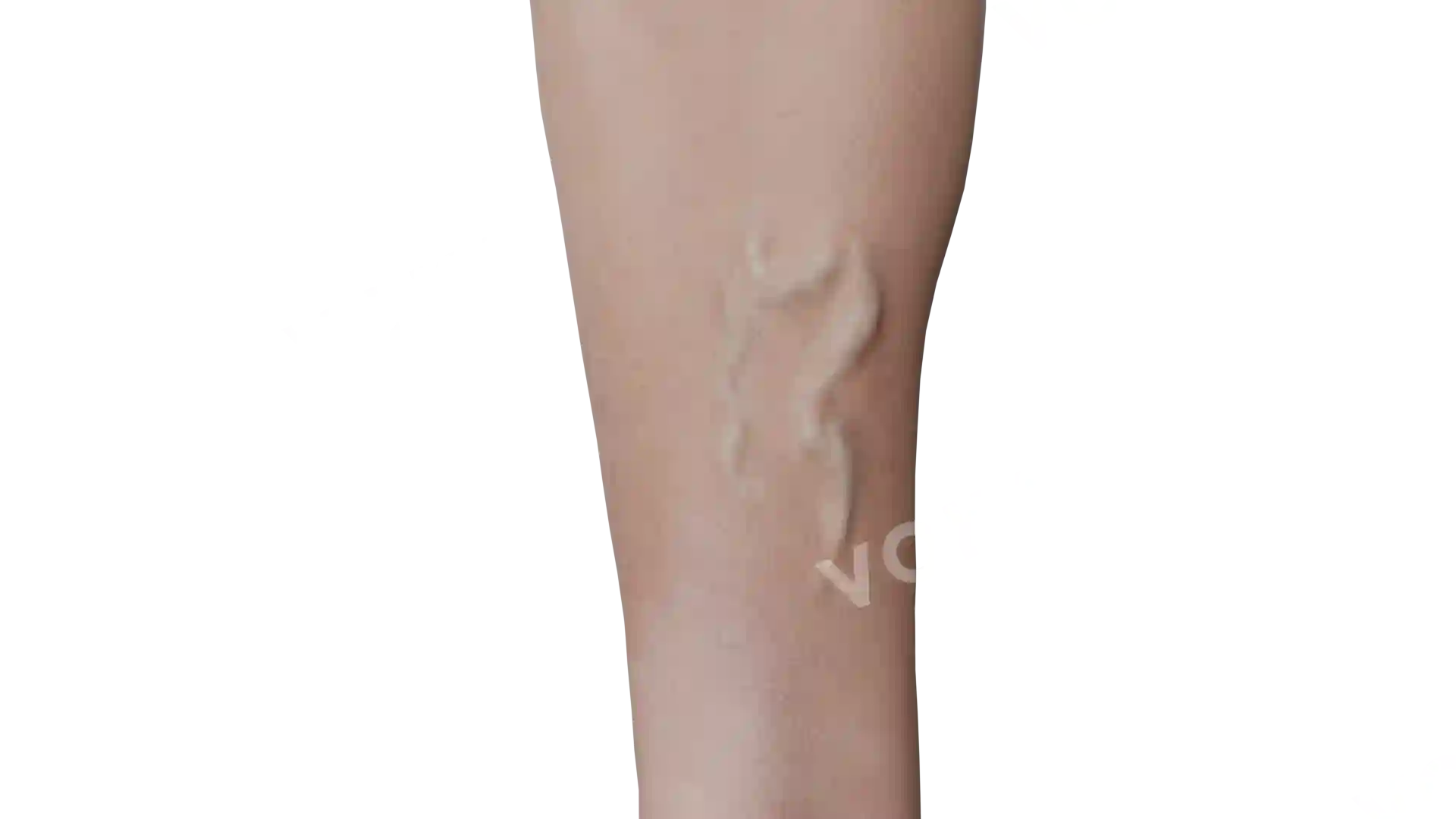Dilated tortuous great saphenous vein image