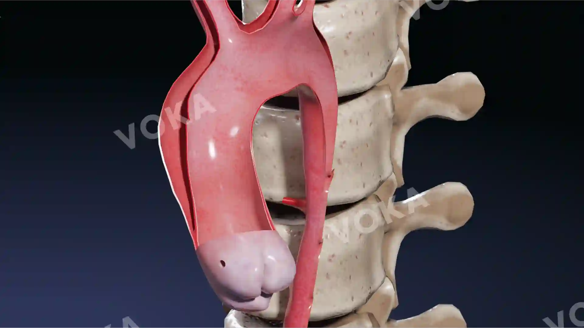Dissection of the ascending aorta involving the branches of the aortic arch image