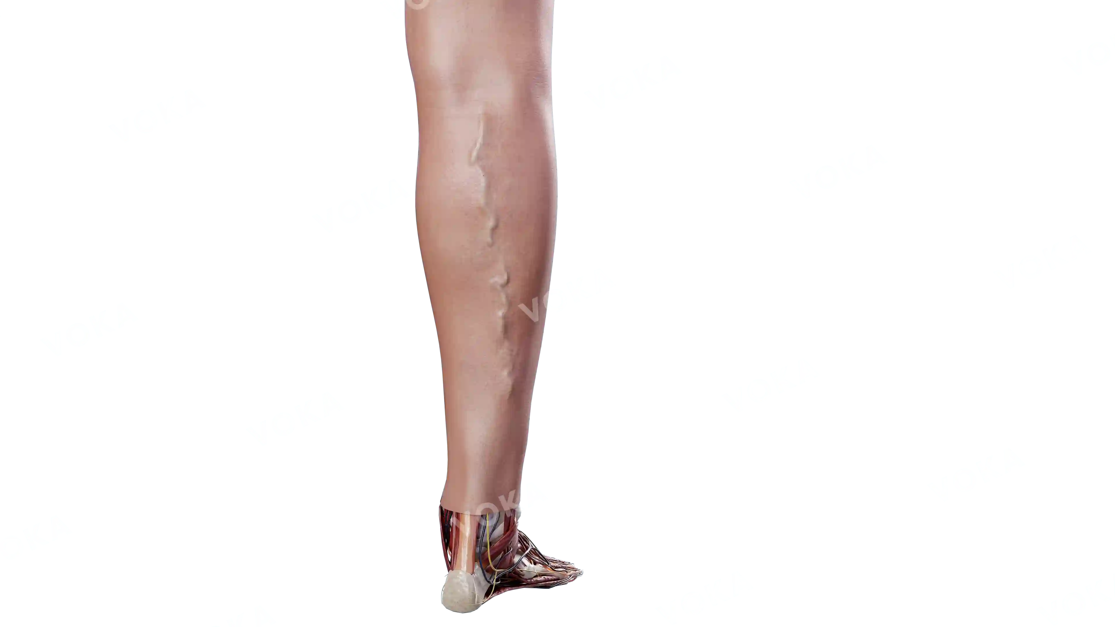 Dilated tortuous small saphenous vein image