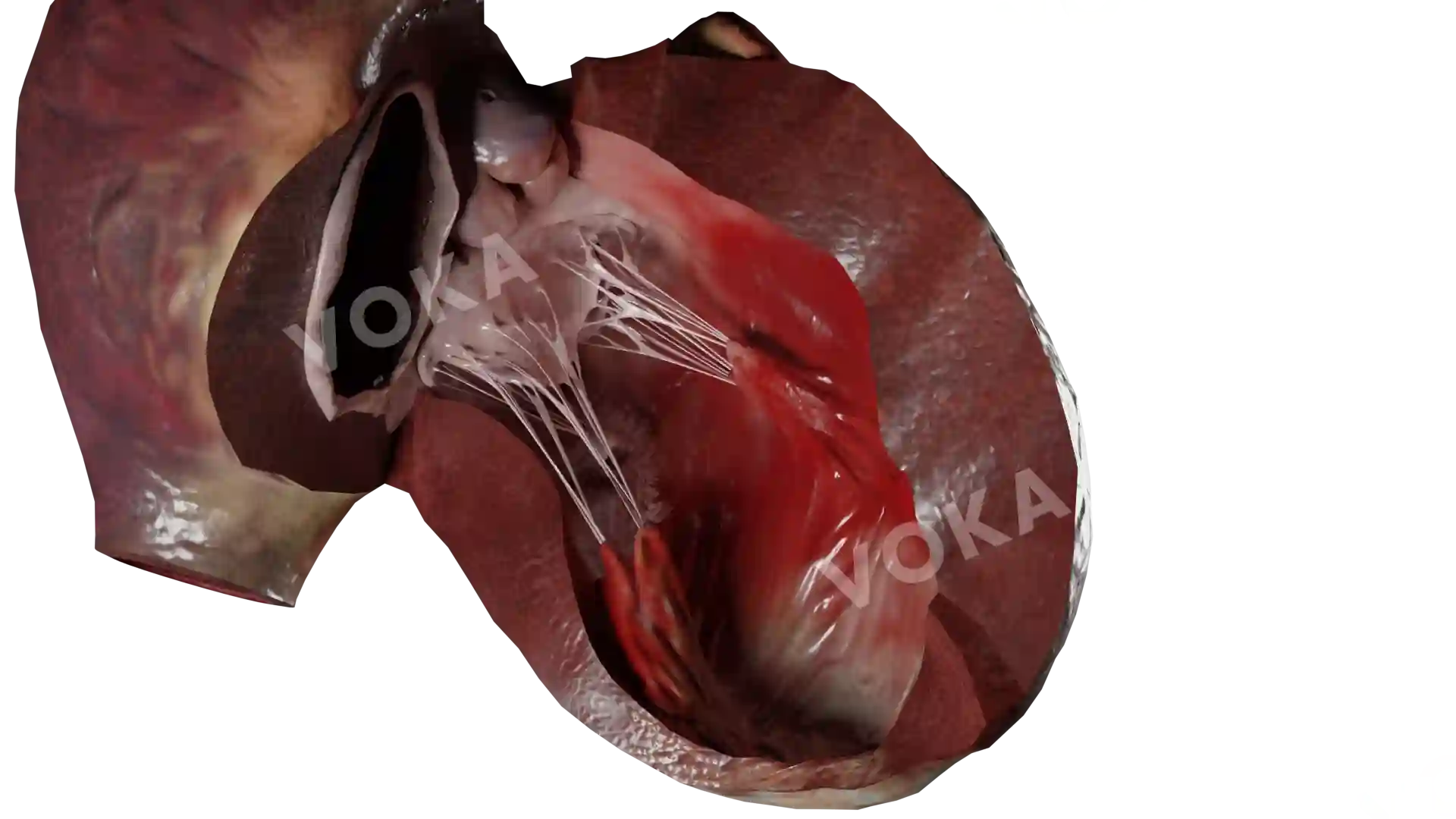 Postinfarction complications image