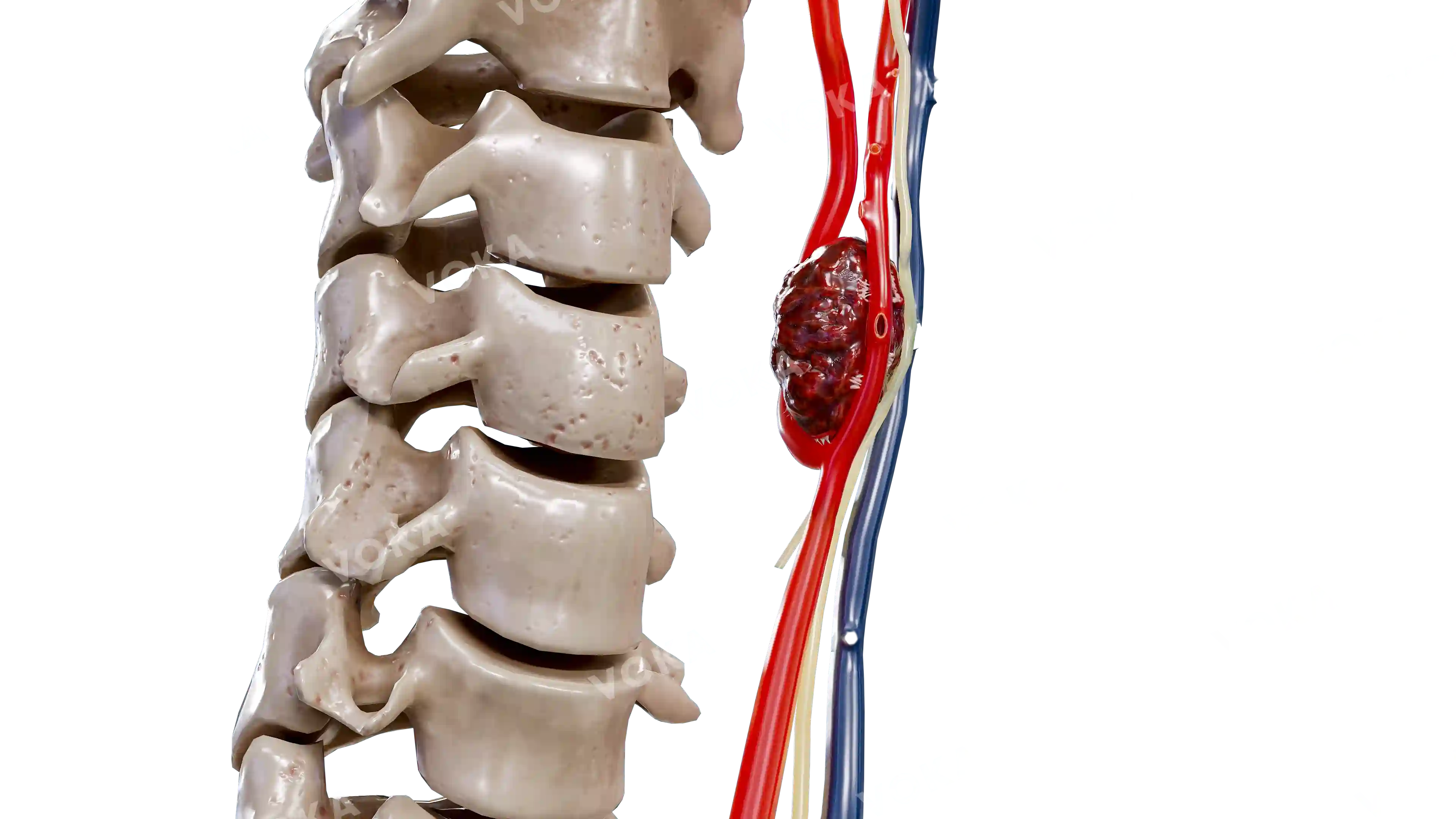 Paraganglioma image