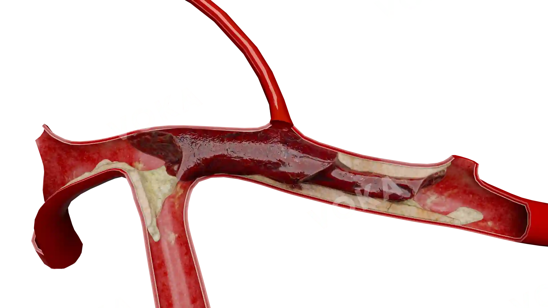 Thrombosis of subclavian artery image