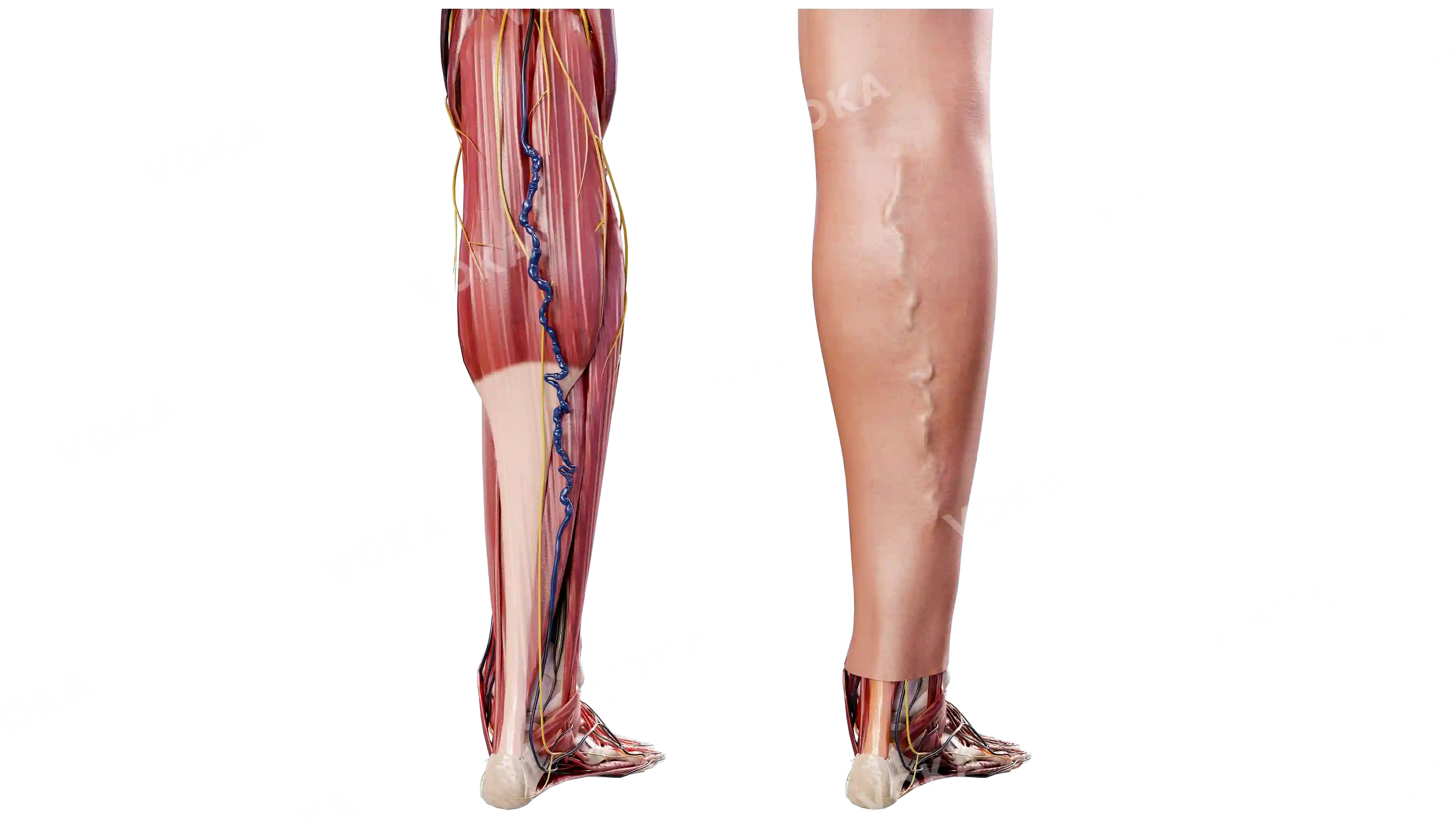 Varicose veins of the legs image