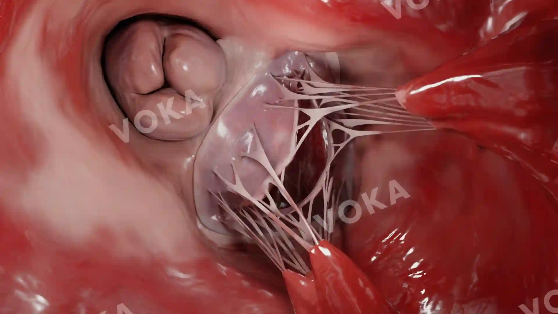 Mitral regurgitation due to LV dilatation and annulus dilation image