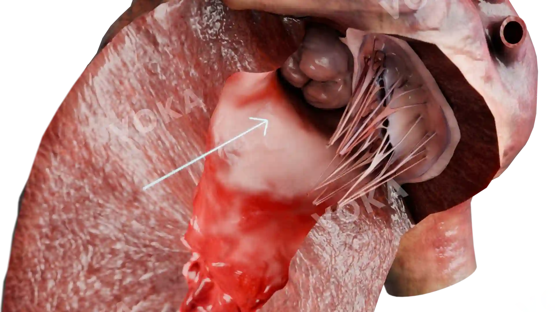 Obstruction of outflow tract due to interventricular septum thickening  image