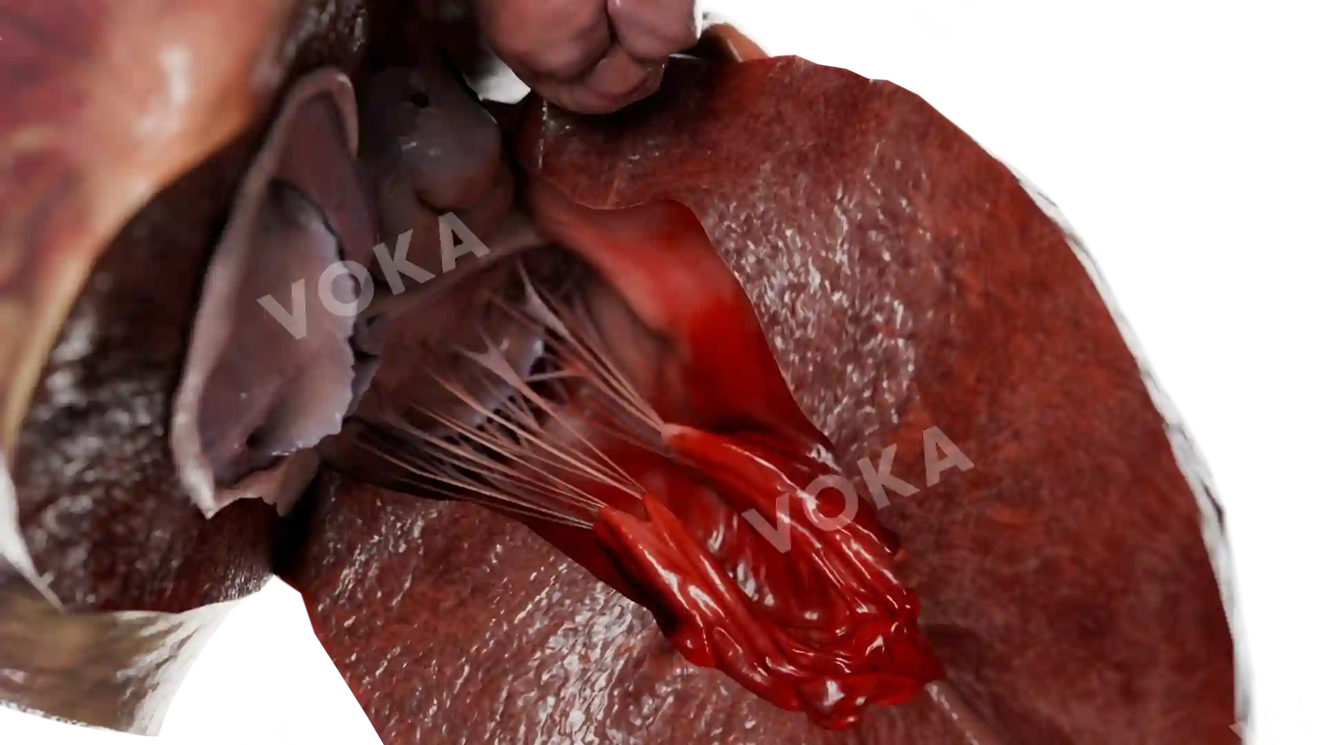 Thickened left ventricle wall in HCM image