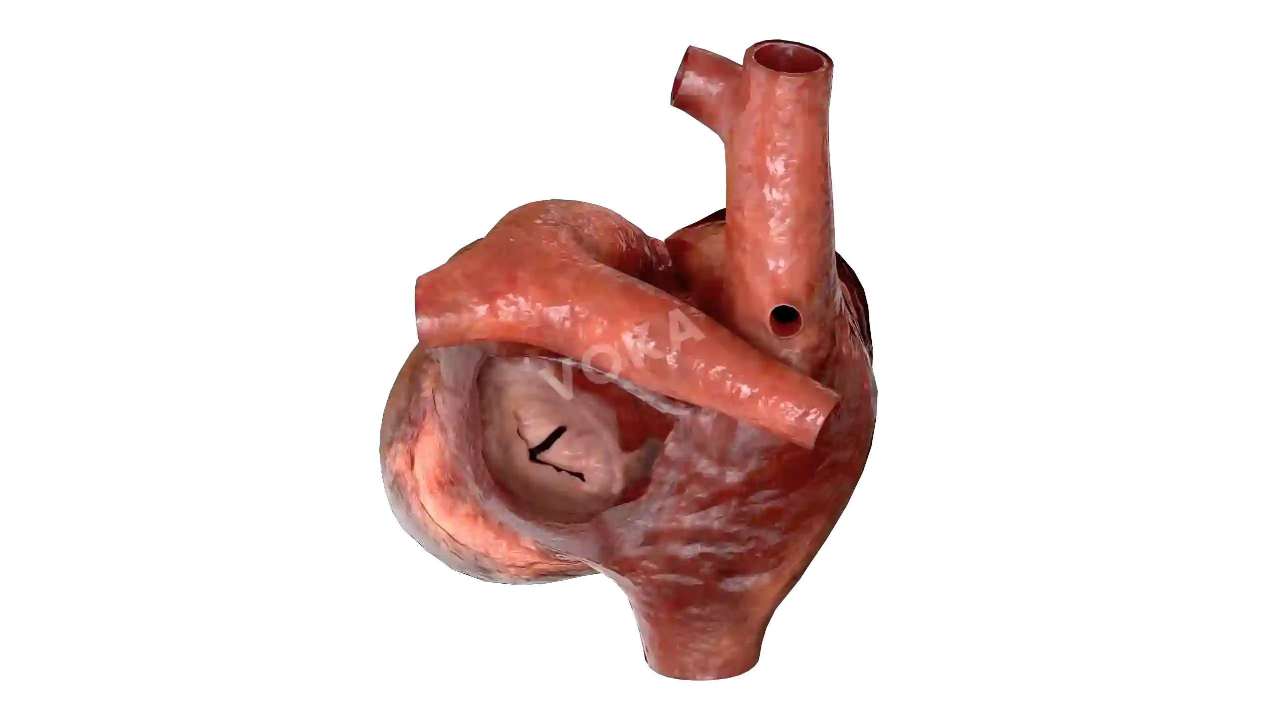 Atrioventricular canal defect image