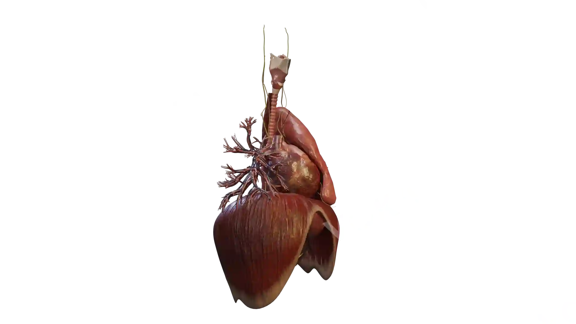 Heart with VSD and its surrounding structures image