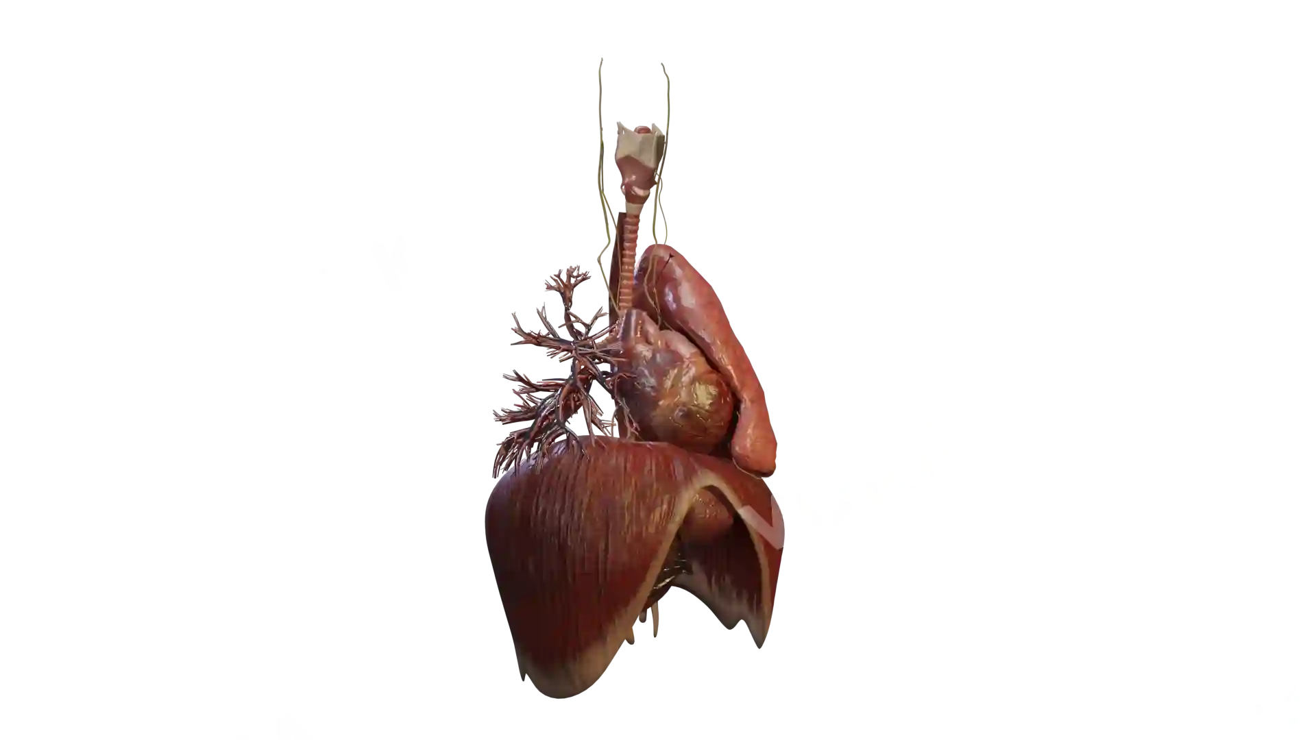 Heart with VSD and its surrounding structures image