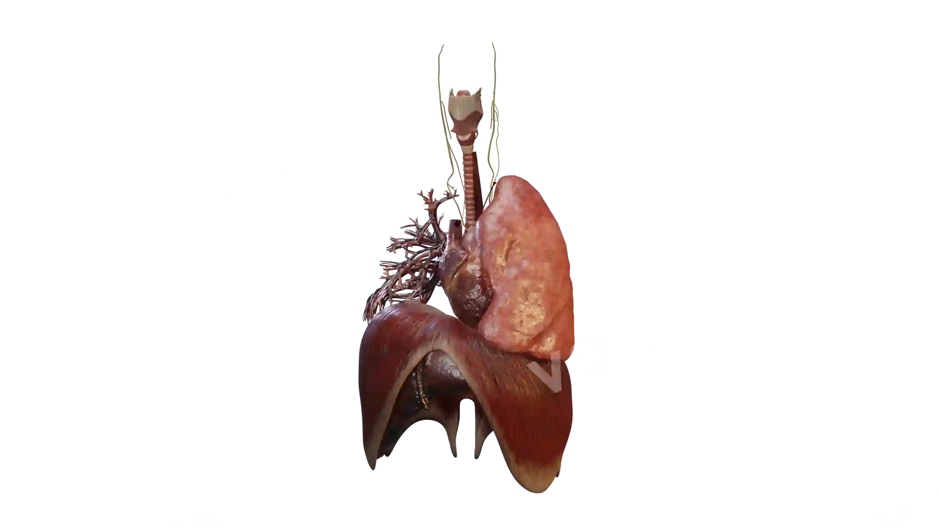 Heart with VSD and its surrounding structures image