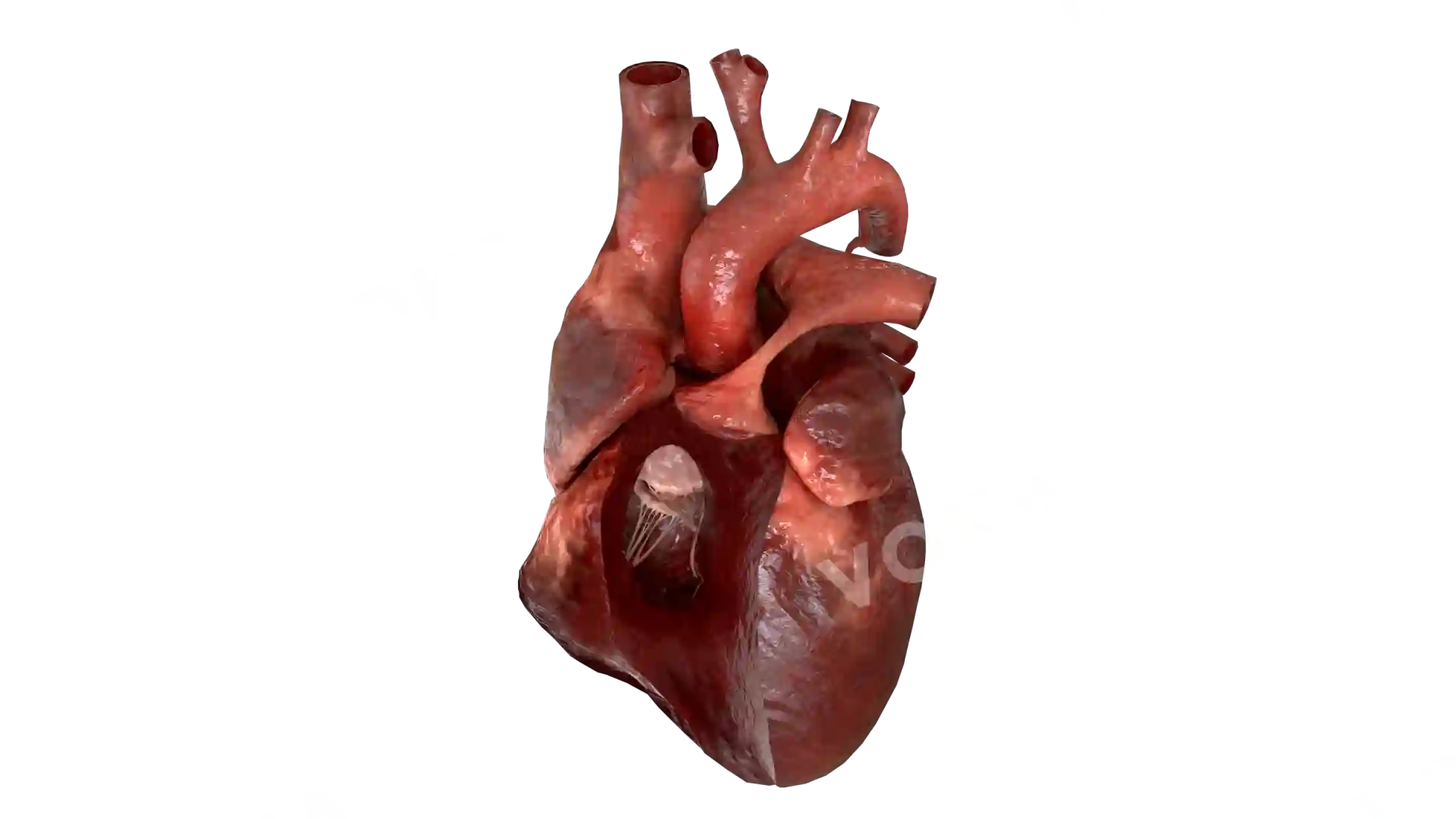 Pulmonary atresia with intact ventricular septum image