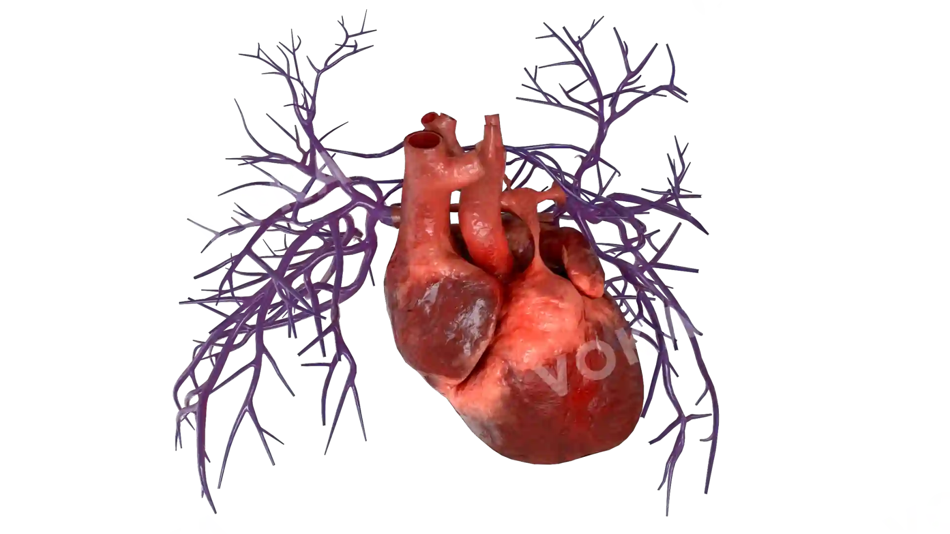 Pulmonary atresia with ventricular septal defect (PA-VSD) image