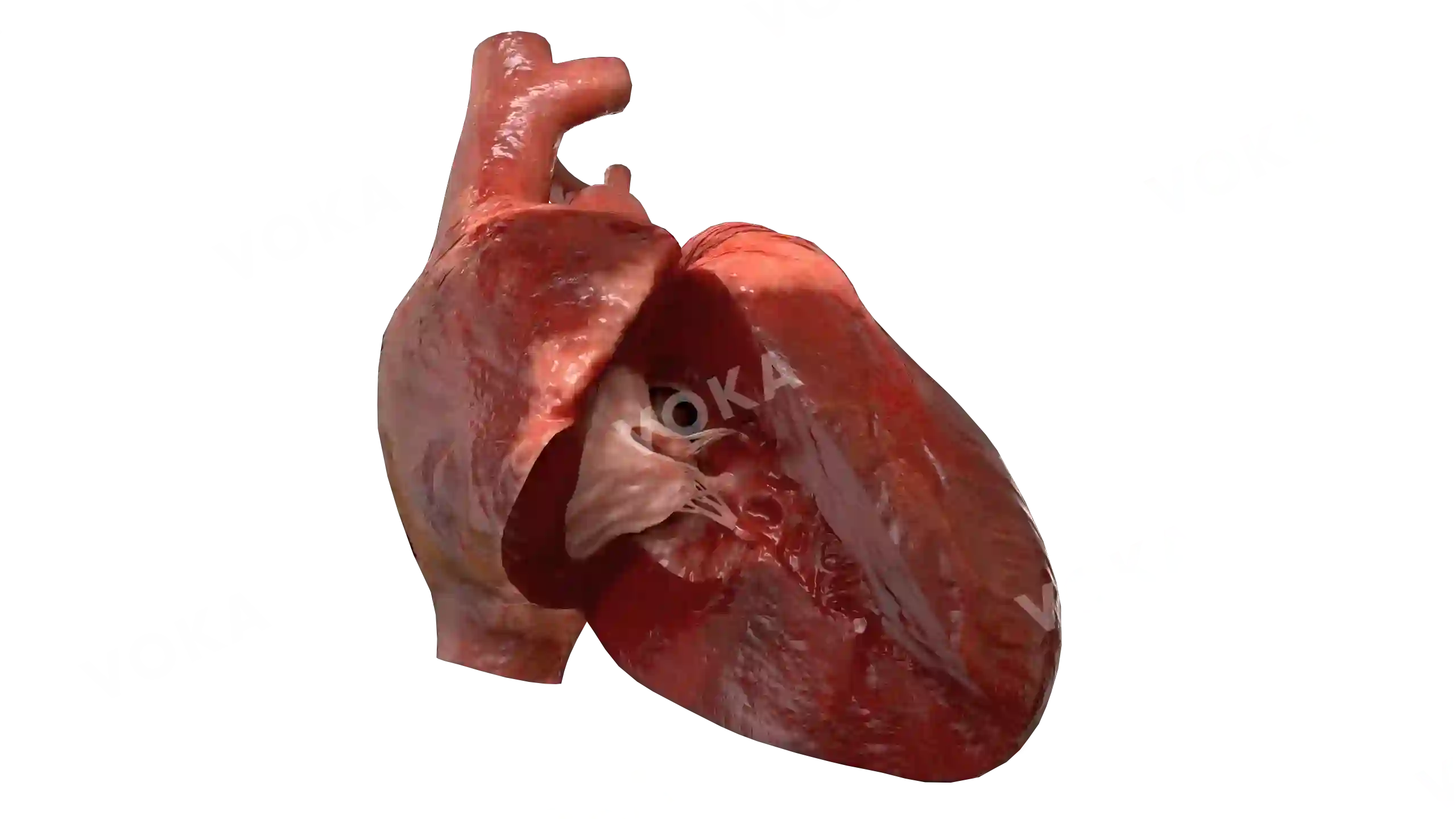 Ventricular septal defect image