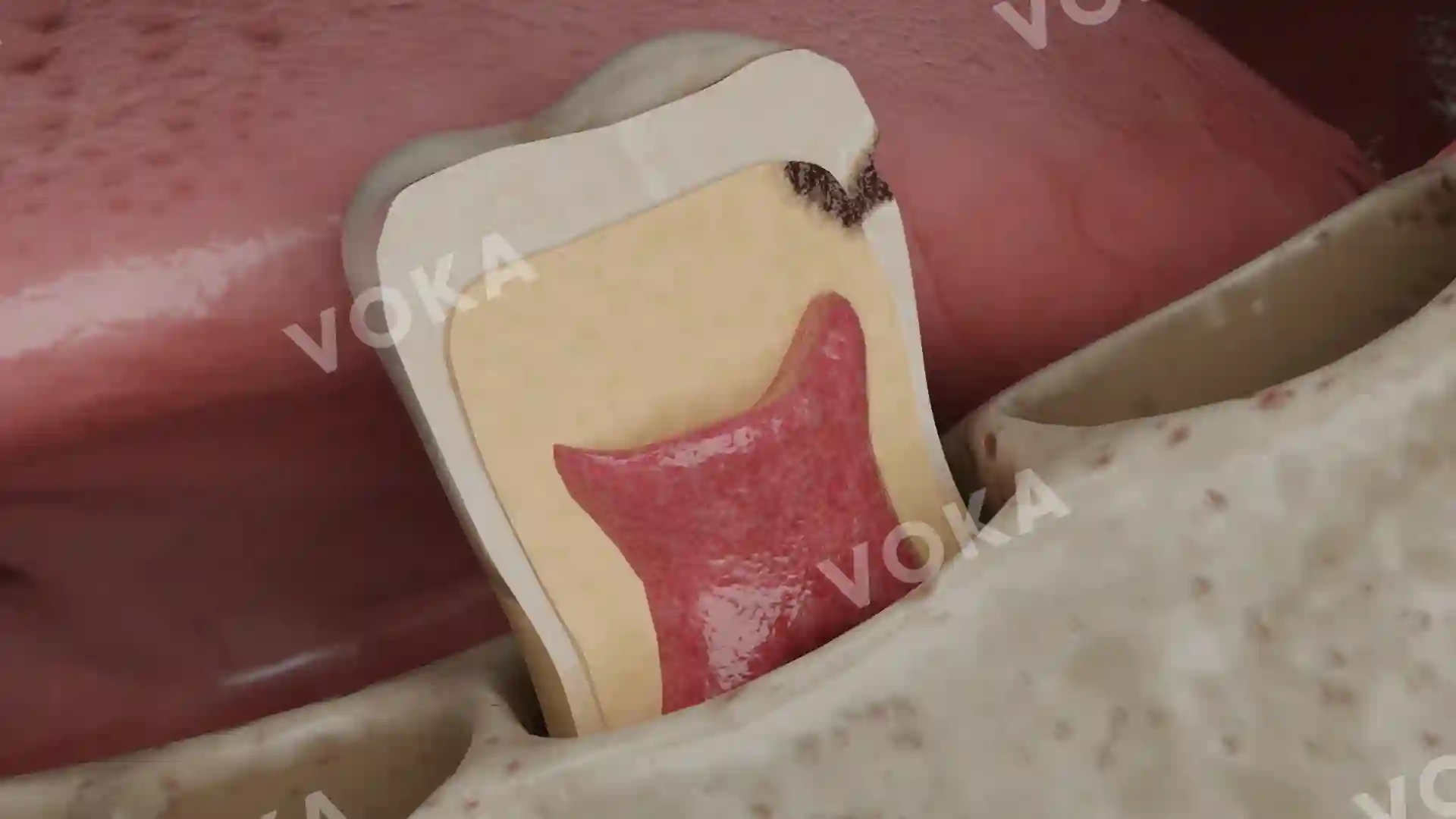 Caries stages according to the radiological classification – Stage D1 image