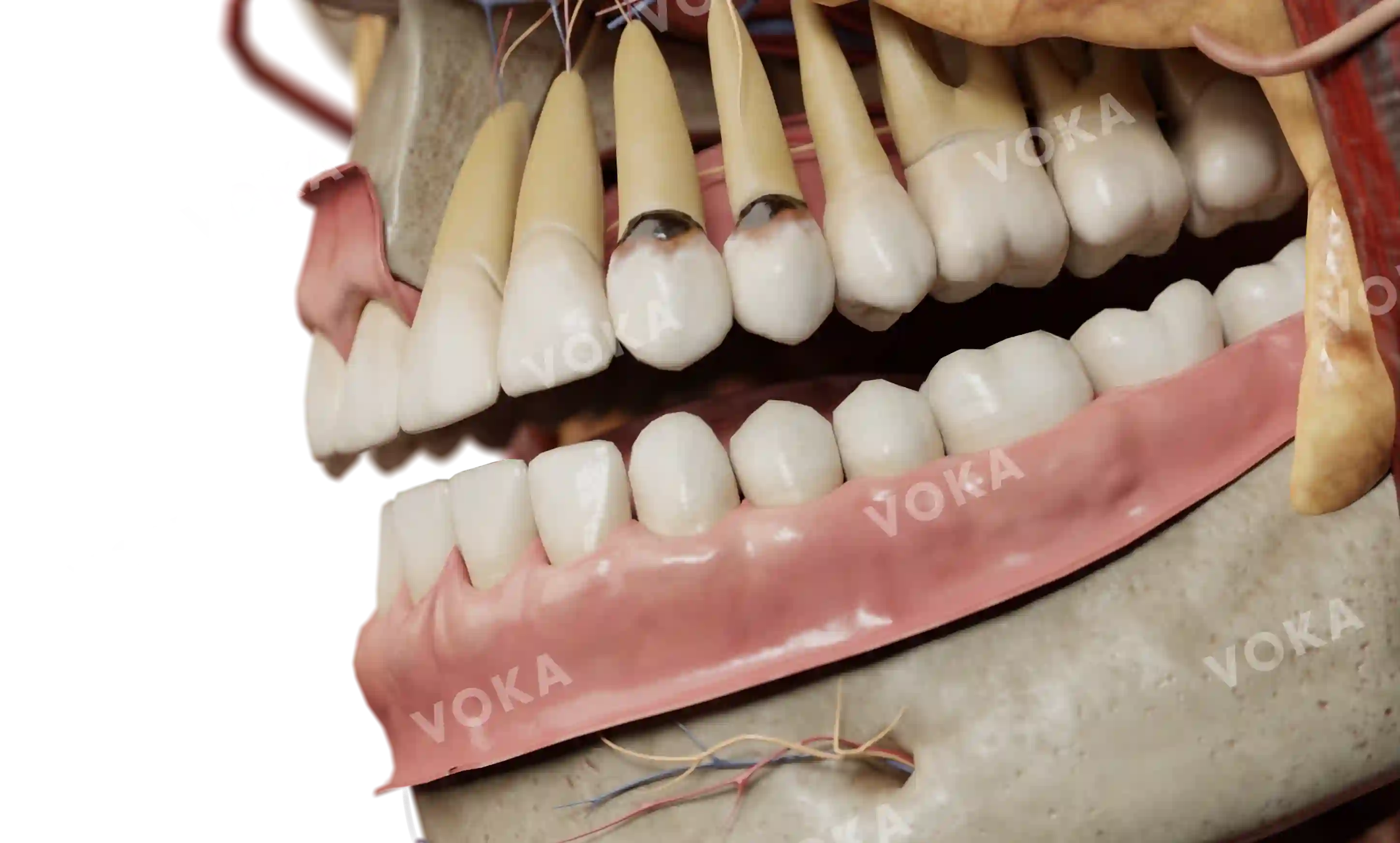 Dental hard tissue discoloration after eruption (caused by the use of silver nitrate) image