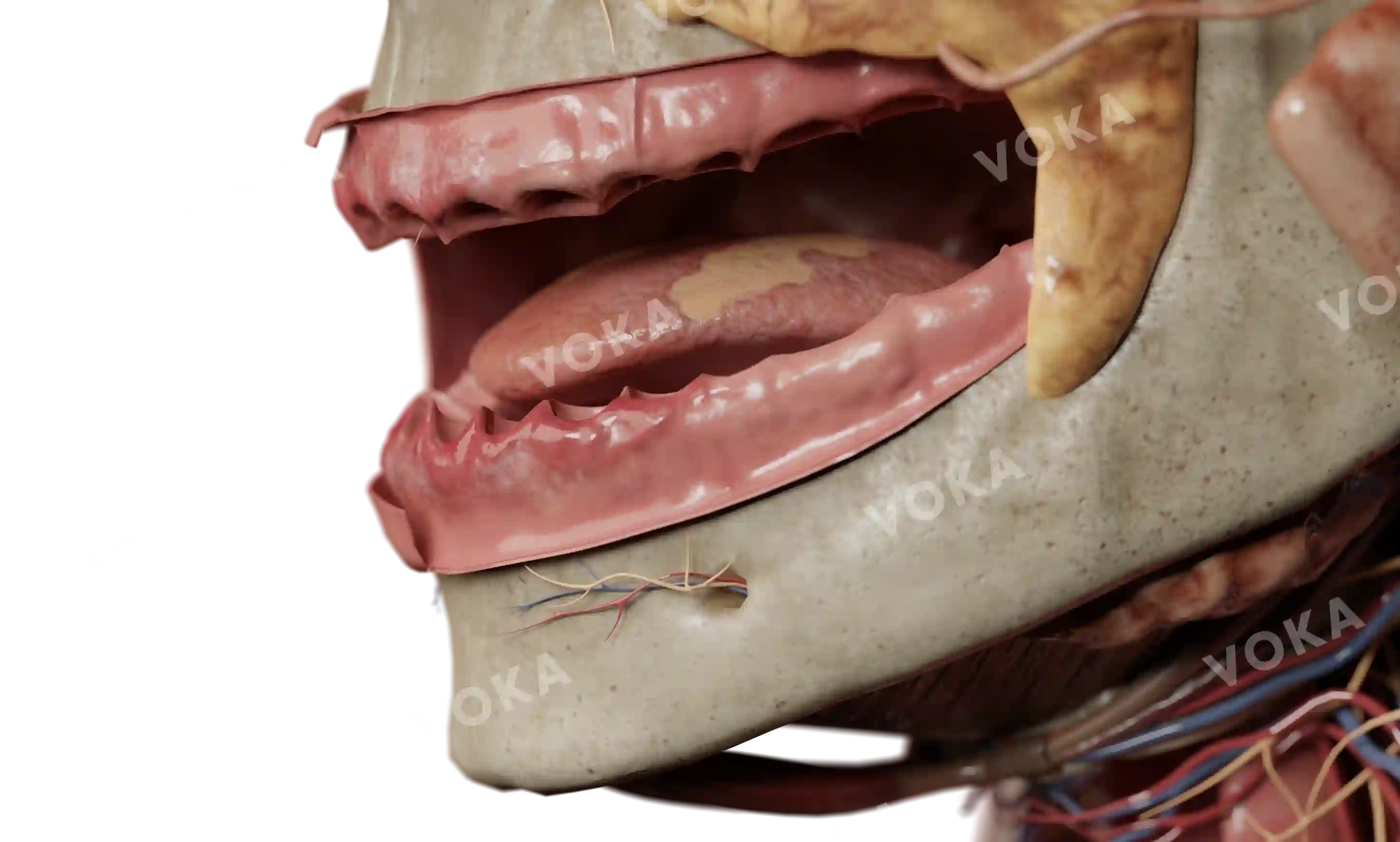 Erosive oral lichen planus on the lateral surface of the tongue image