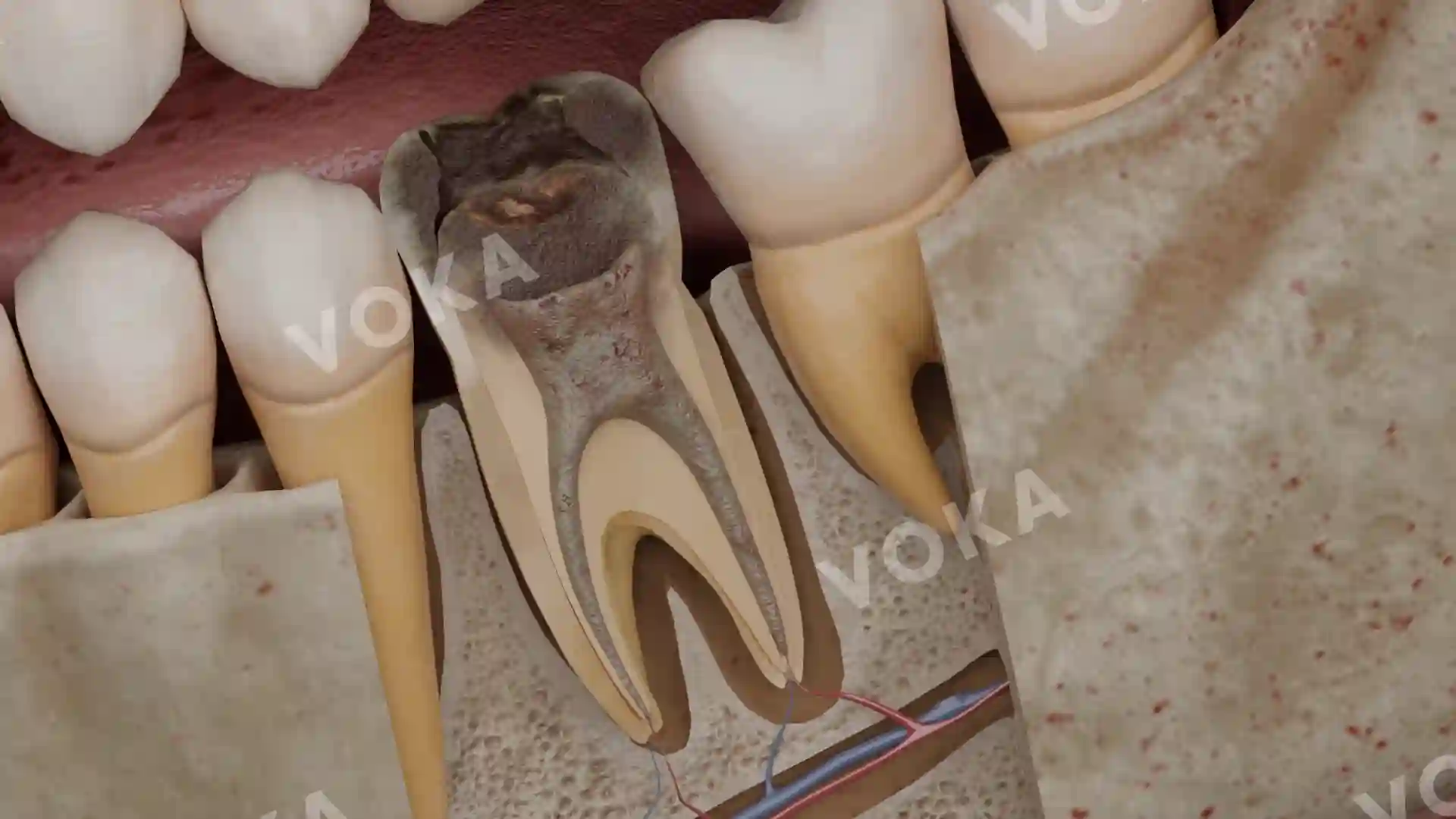 Necrosis of the tooth pulp image