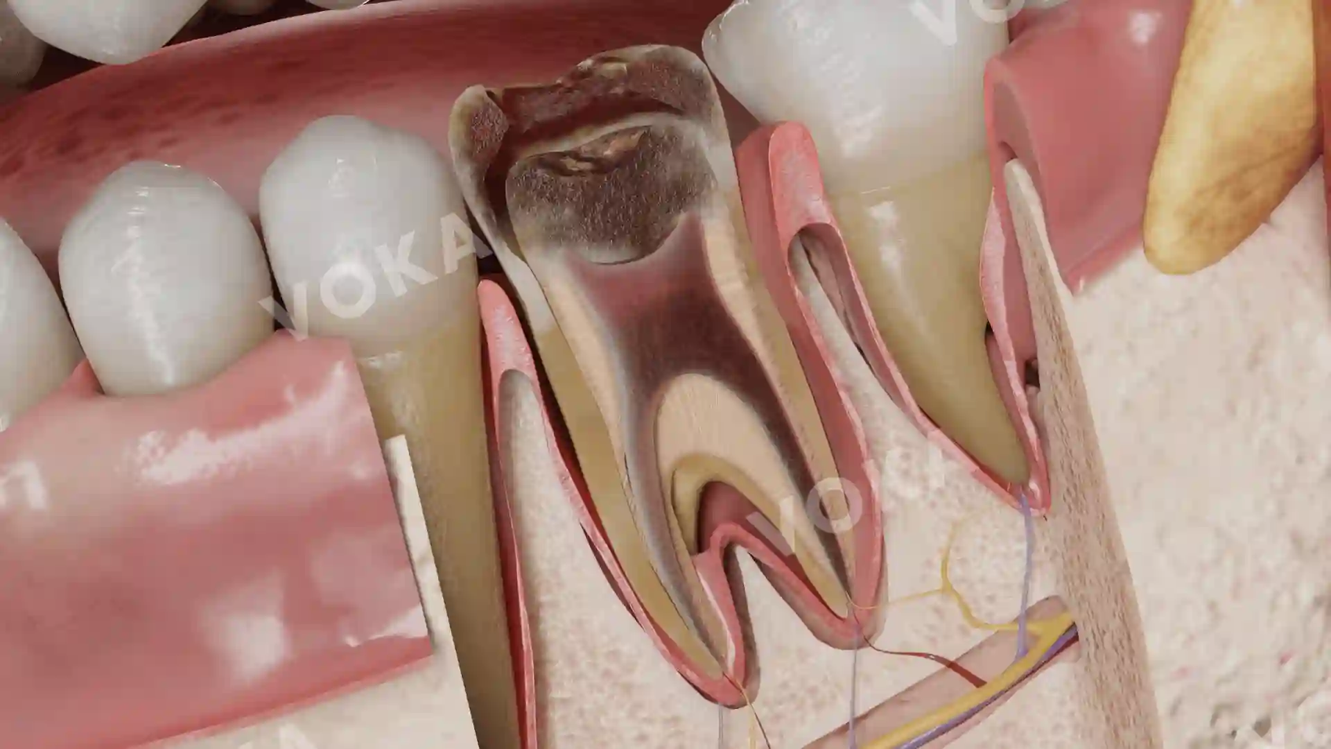 Pulp replacement with scar tissue in chronic irreversible pulpitis image