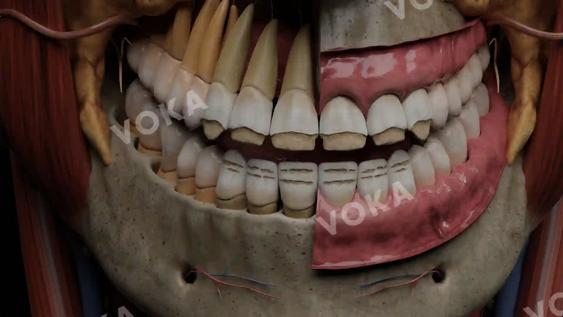 Systemic enamel hypoplasia (striated) image
