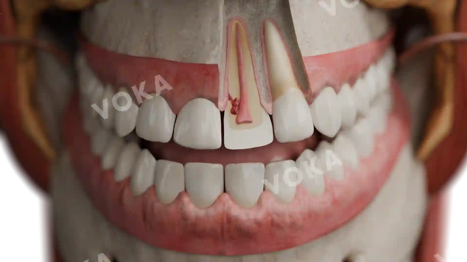 External cervical resorption: class 2 near the pulp image