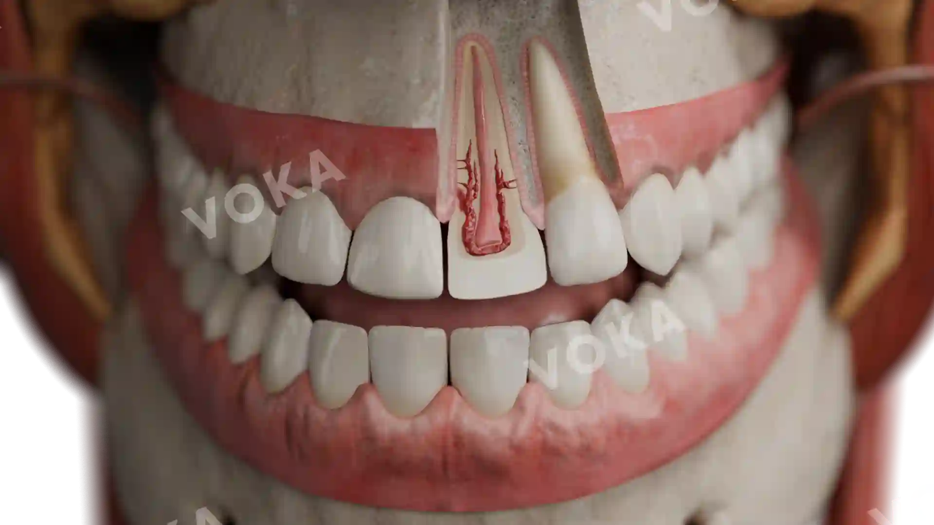 External cervical resorption: class 4 affecting middle and apical third of root image