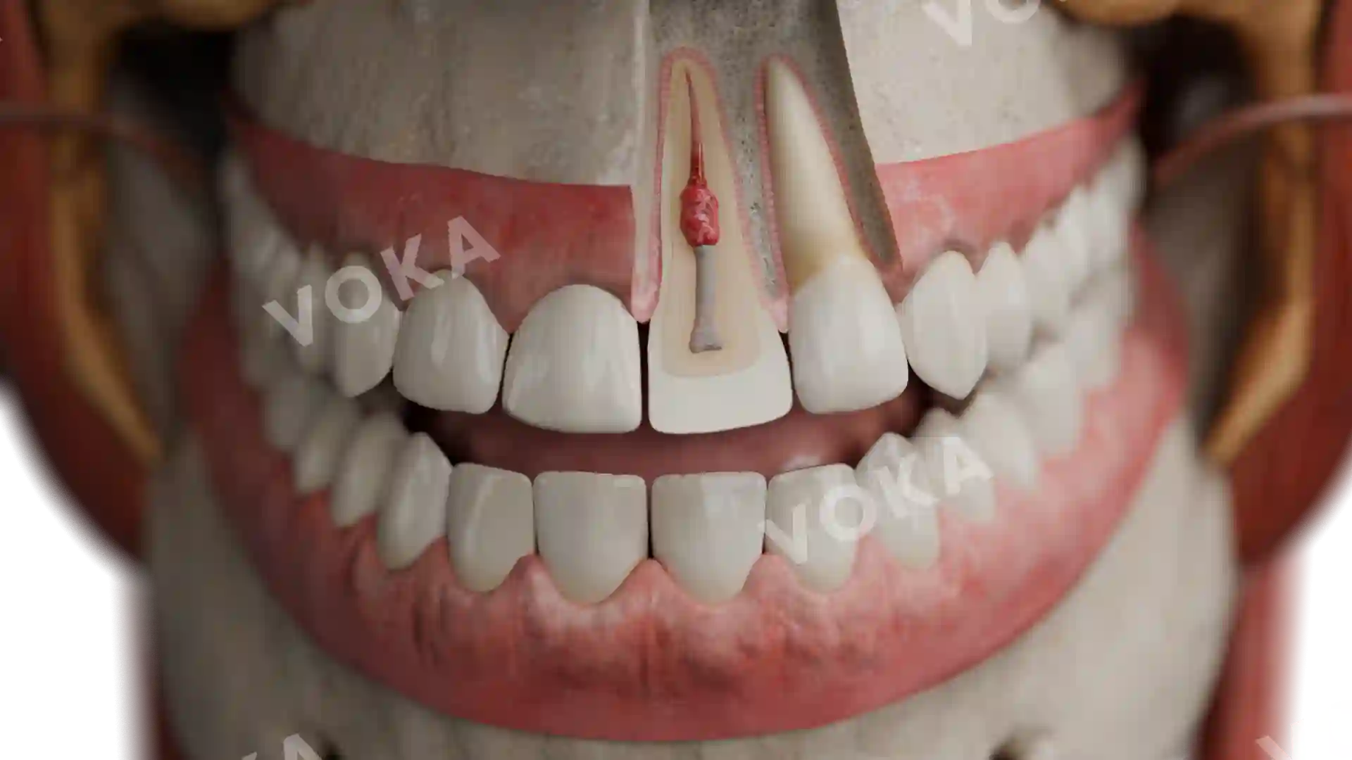Internal inflammatory resorption image