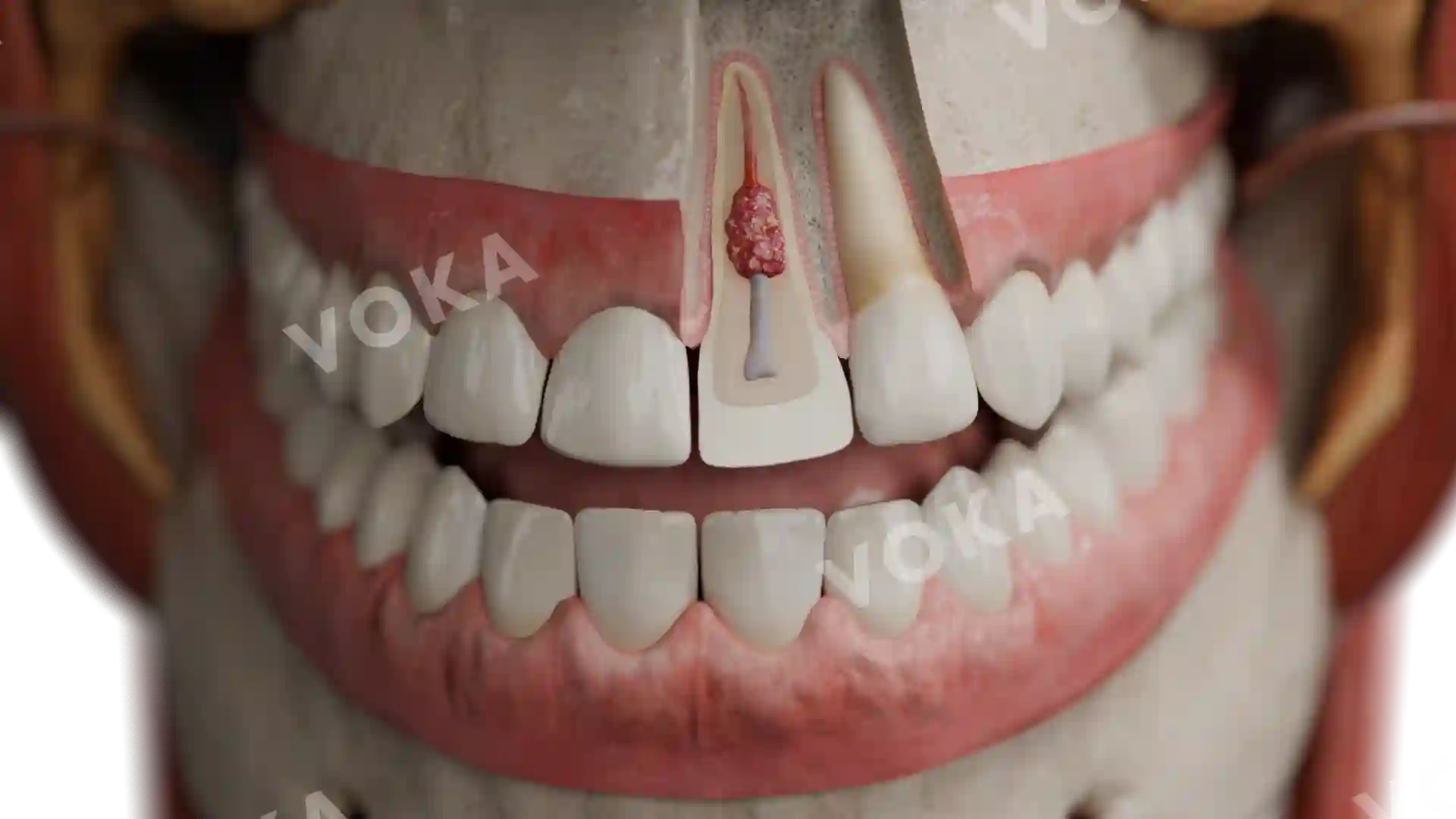 Internal replacement resorption image