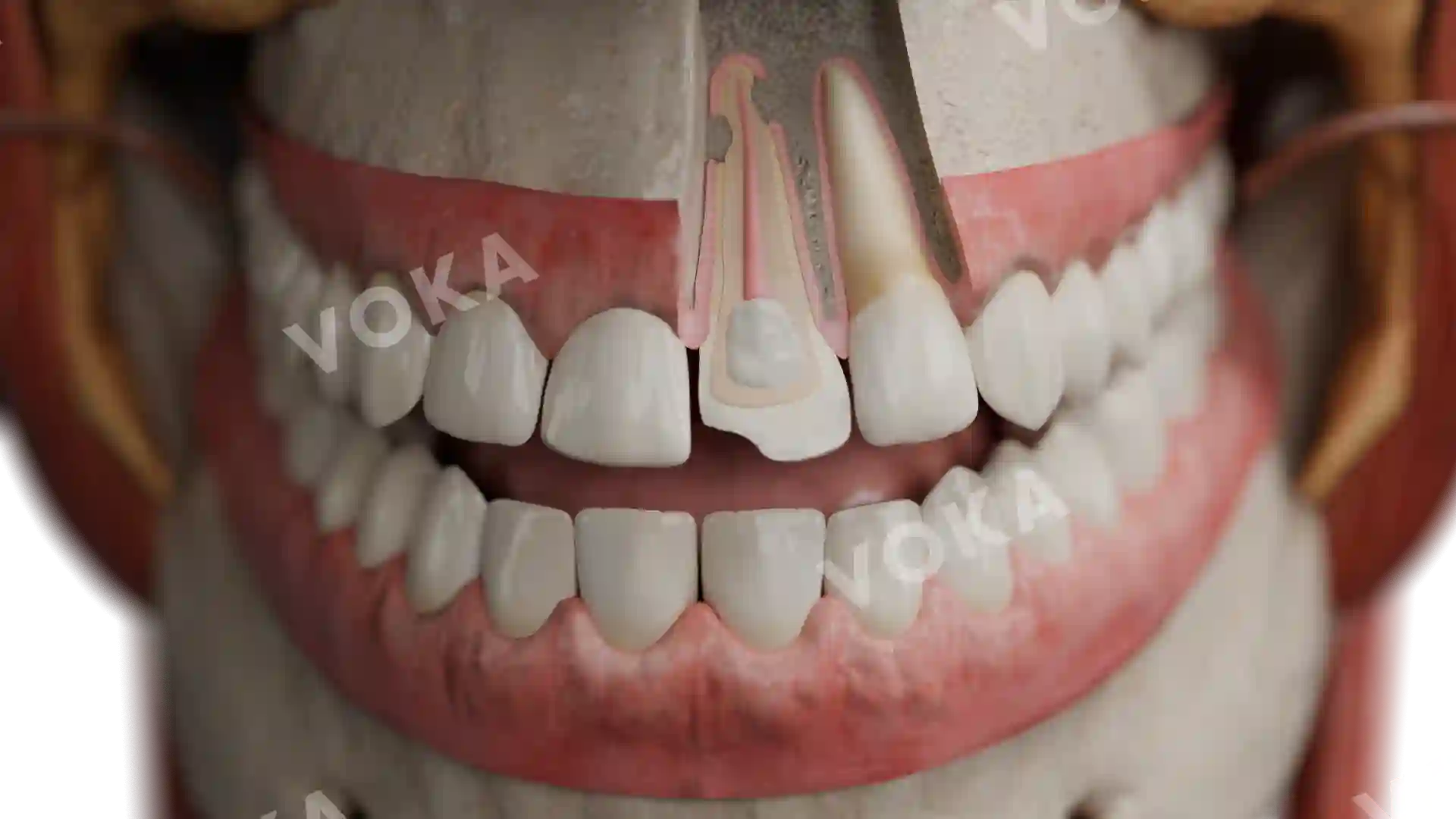 Replacement resorption image