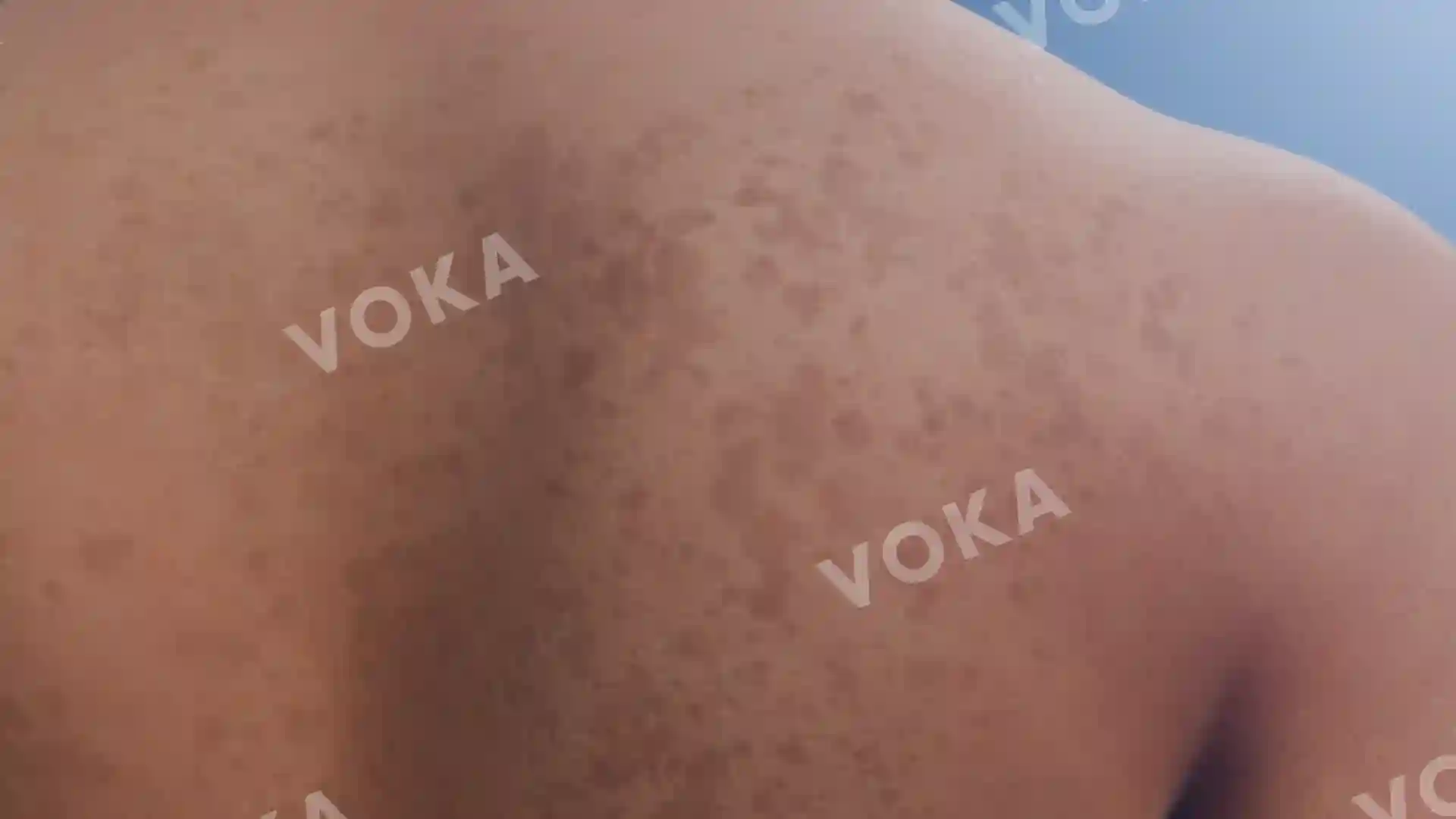 Pityriasis versicolor under normal lighting image