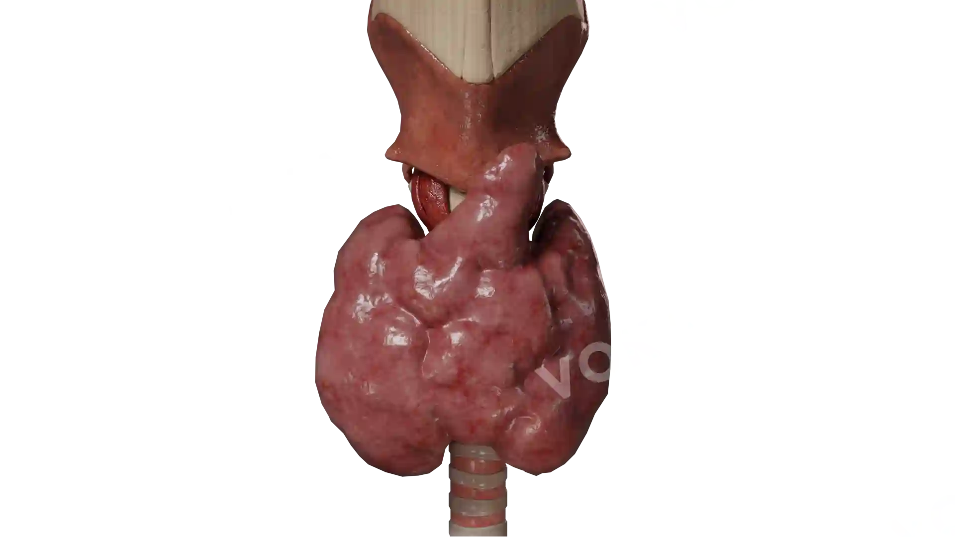 Diffuse goiter image