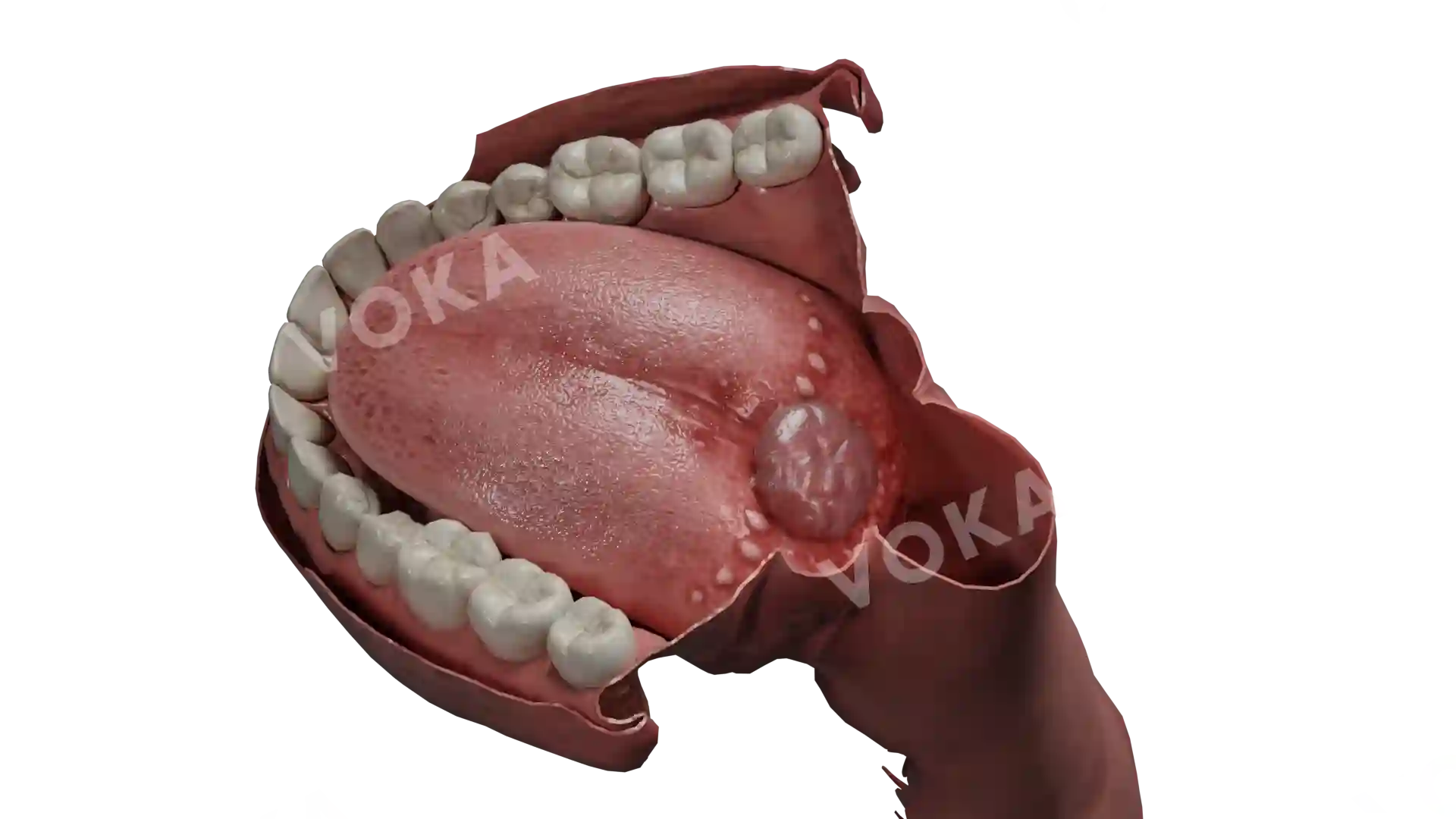 Lingual thyroid ectopia image