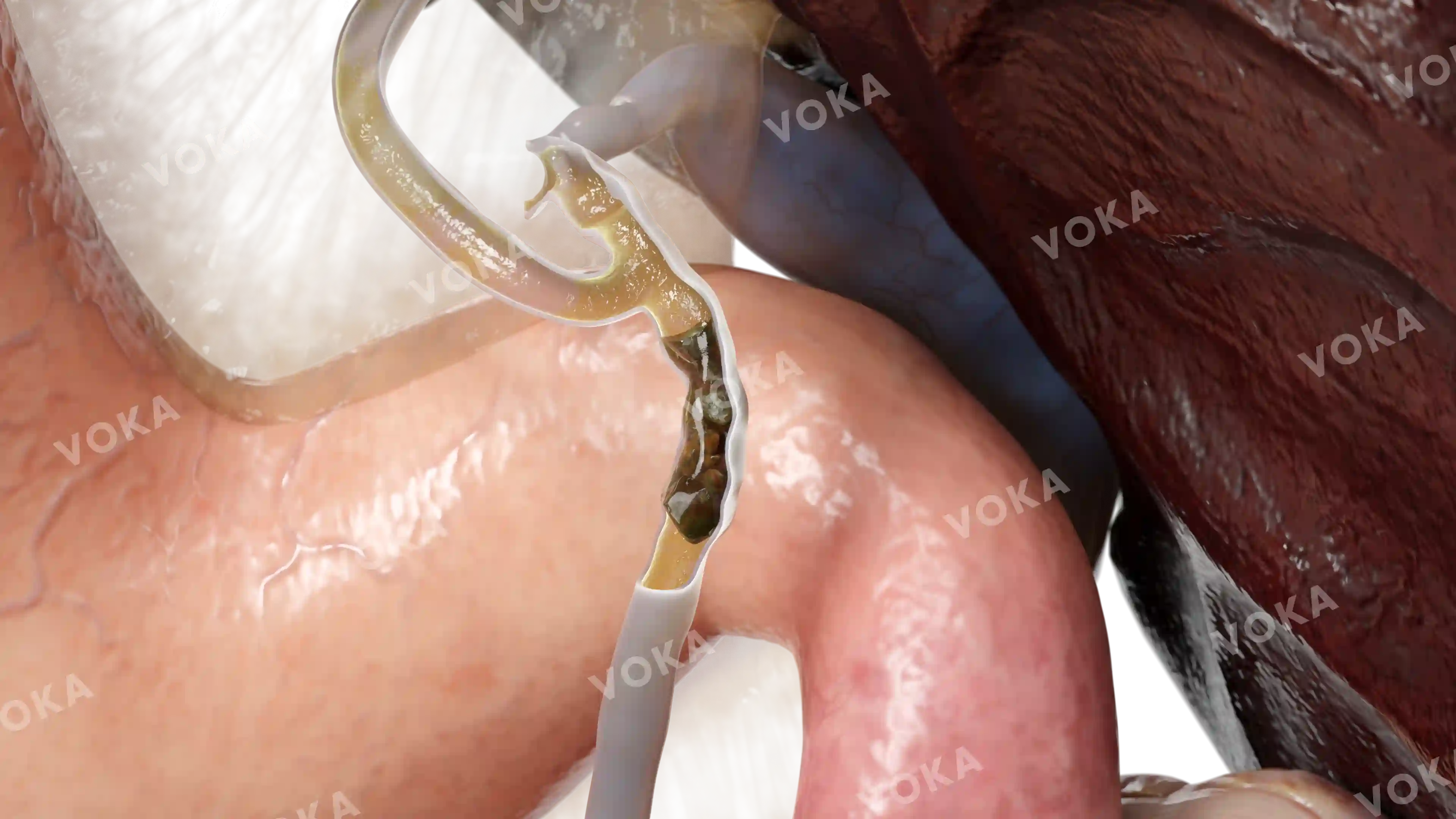 Cholelithiasis image