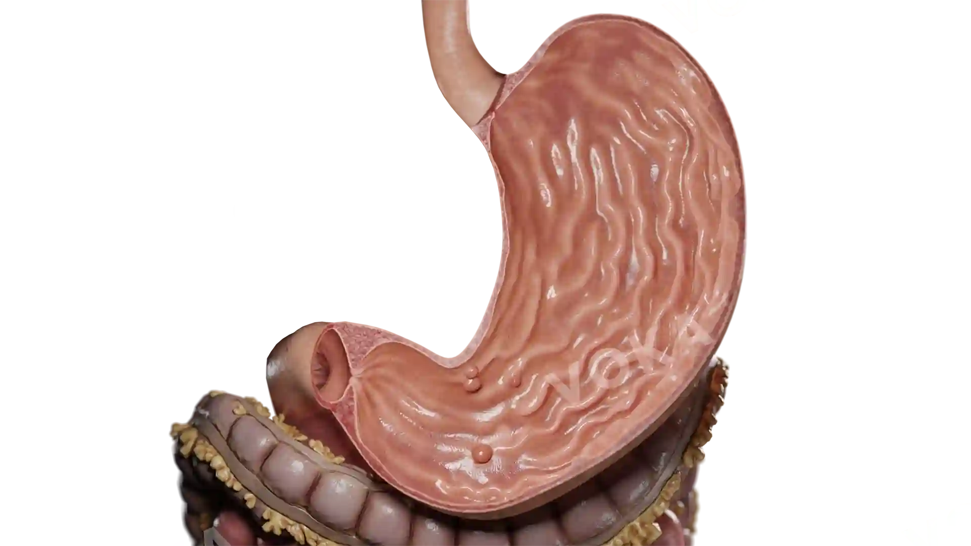 Gastric Polyps image