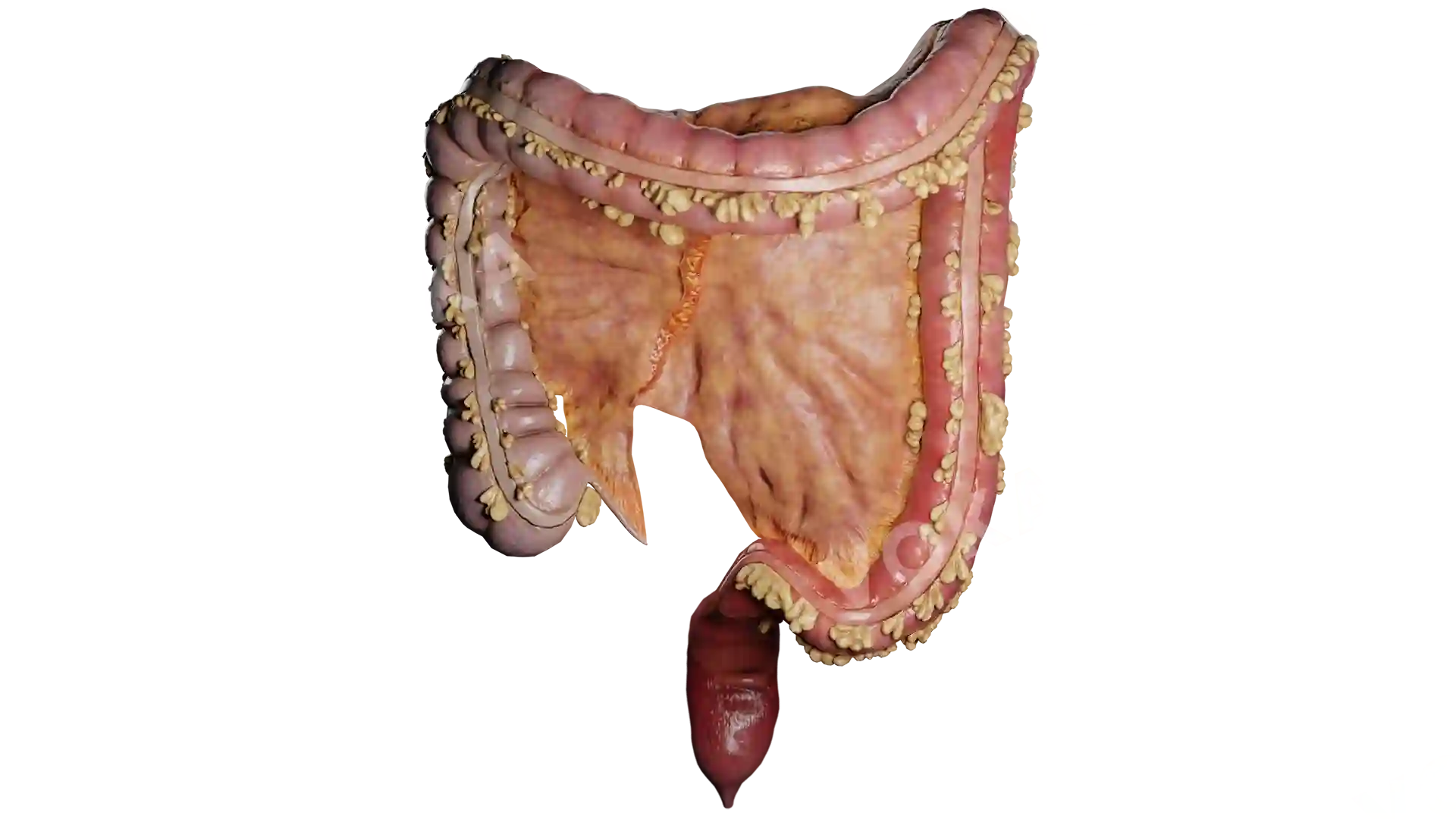 Ulcerative Colitis image