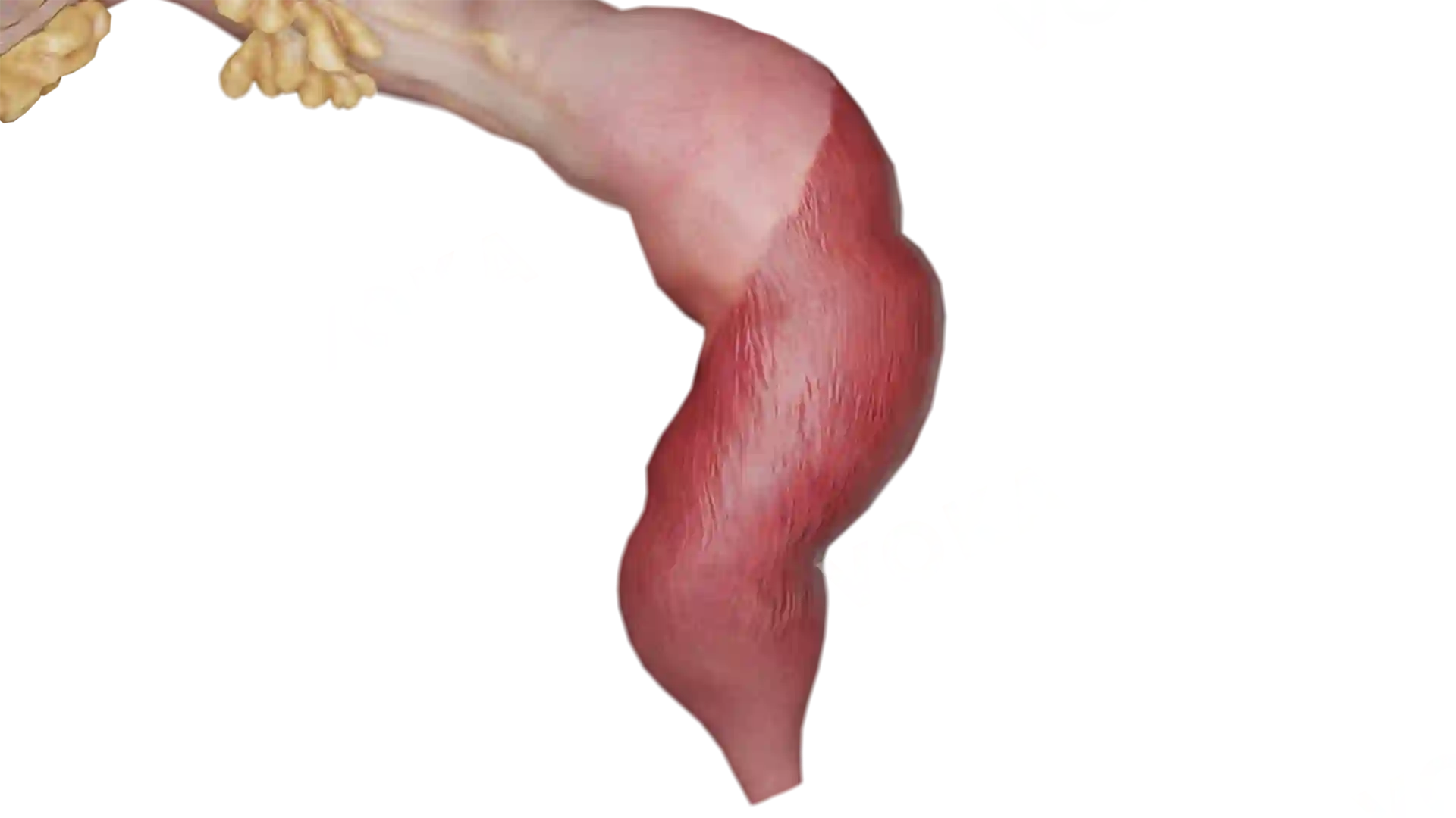 Ulcerative Proctitis image