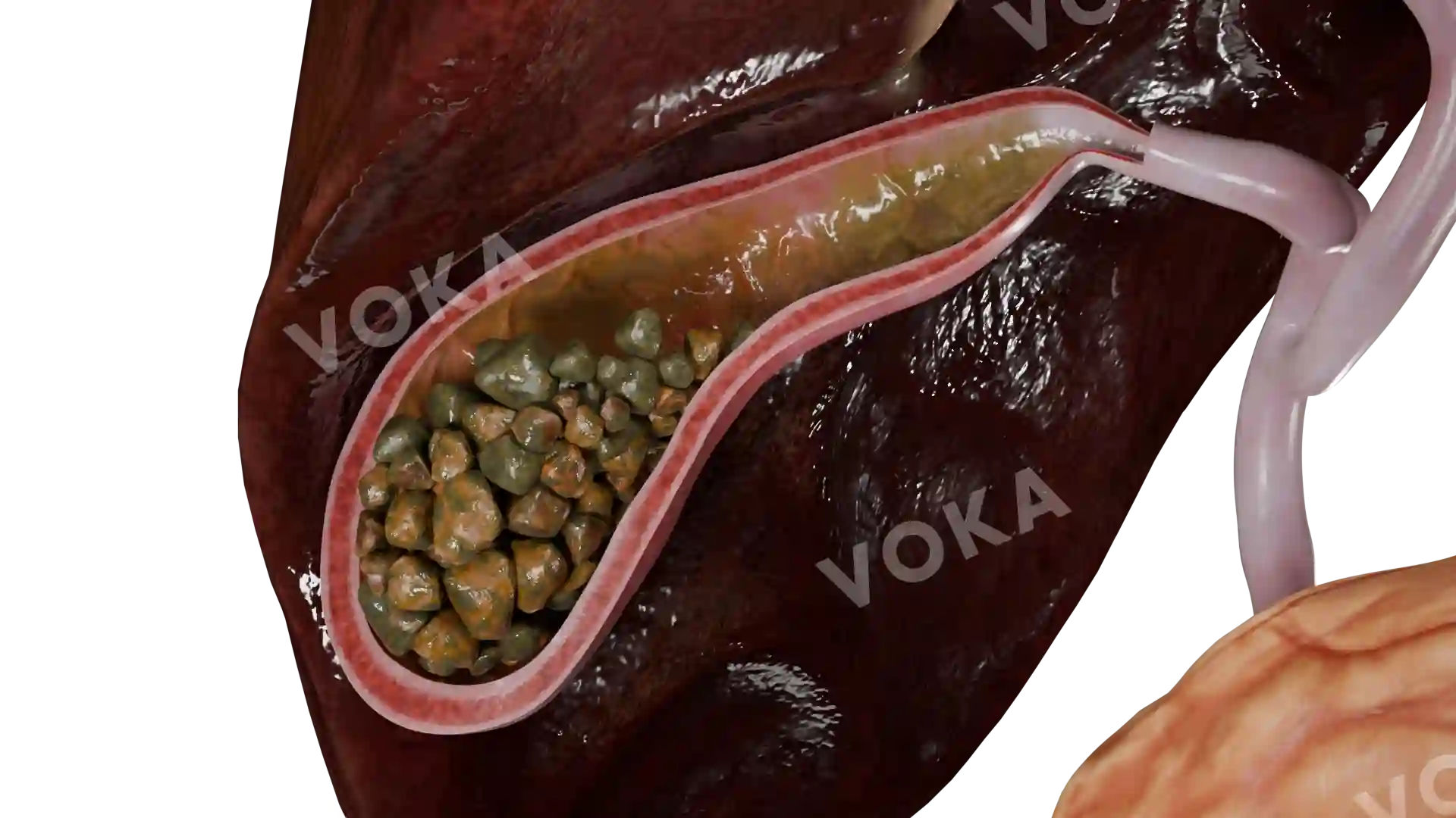 Multiple mixed stones in the gallbladder image