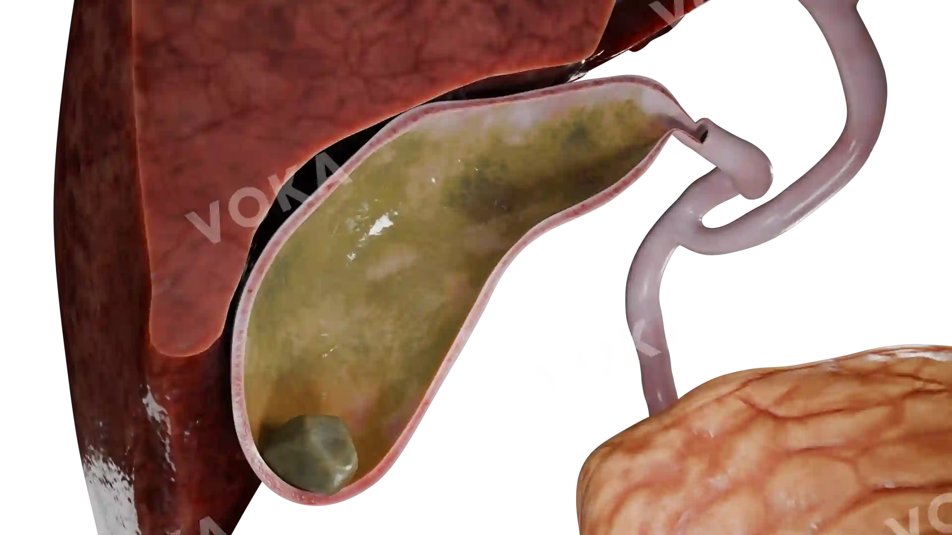 Single mixed stone in the gallbladder image