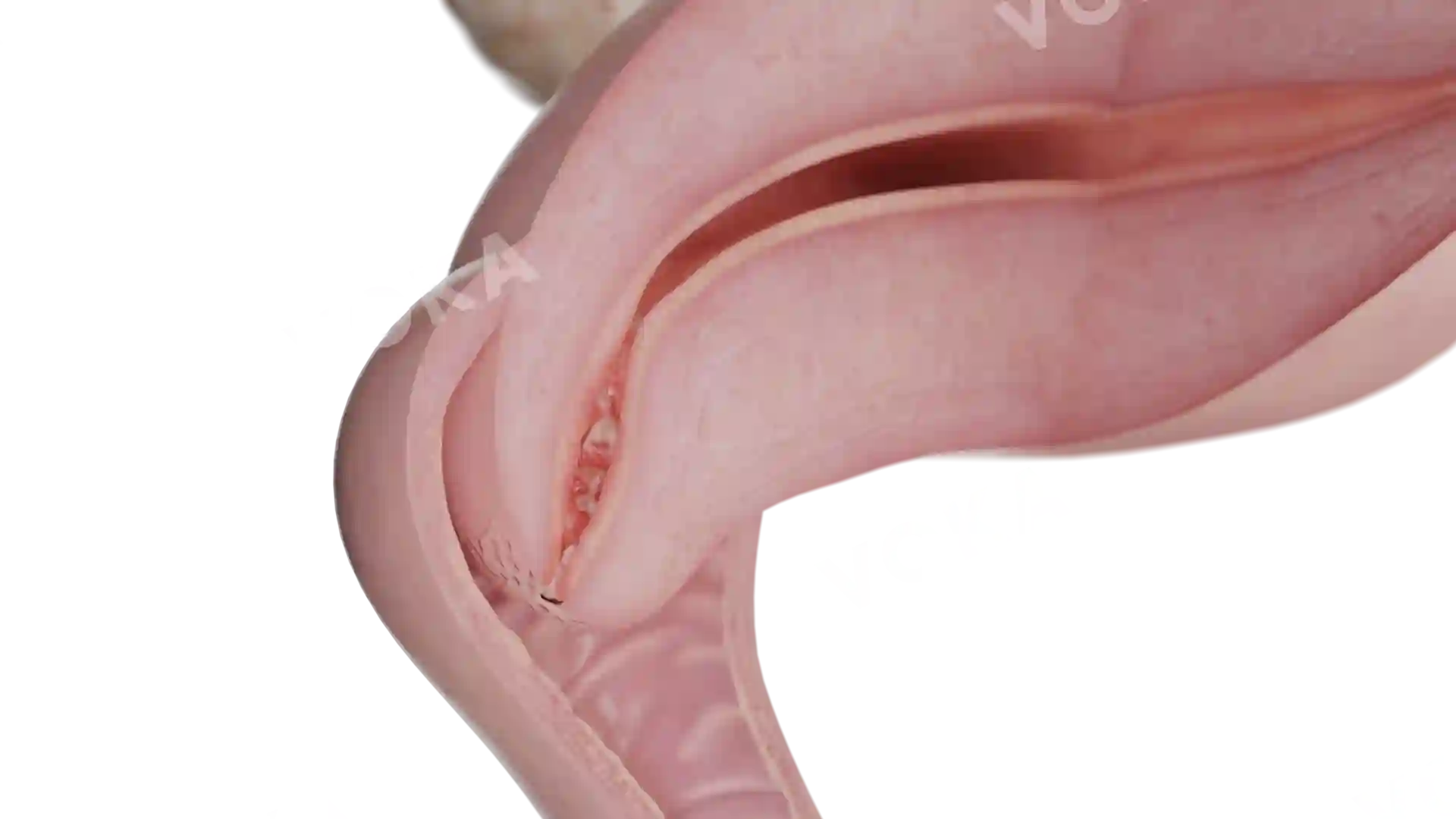 Endocervicitis image