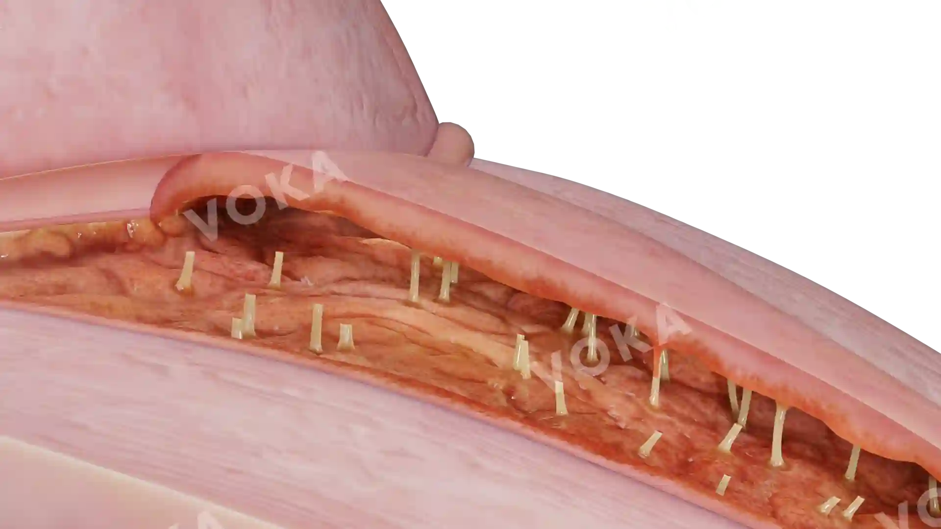 Intrauterine adhesions due to endometritis image