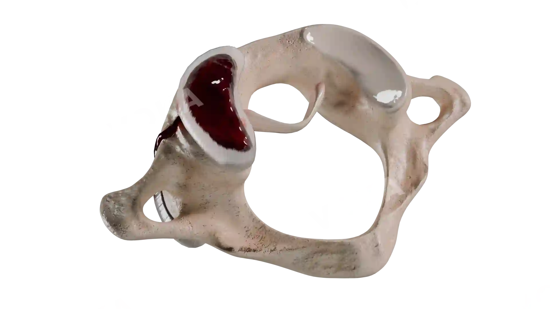 C1 fracture type 4 BD1 4 trv image