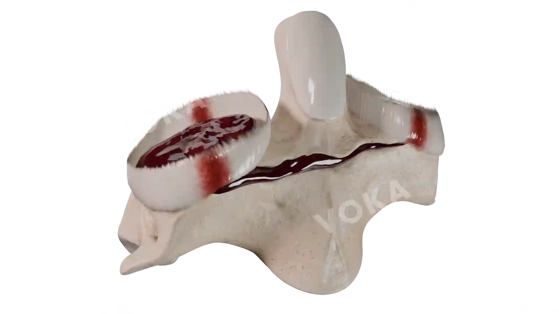 C2 fracture  type 3 BD2 2 4 trv image