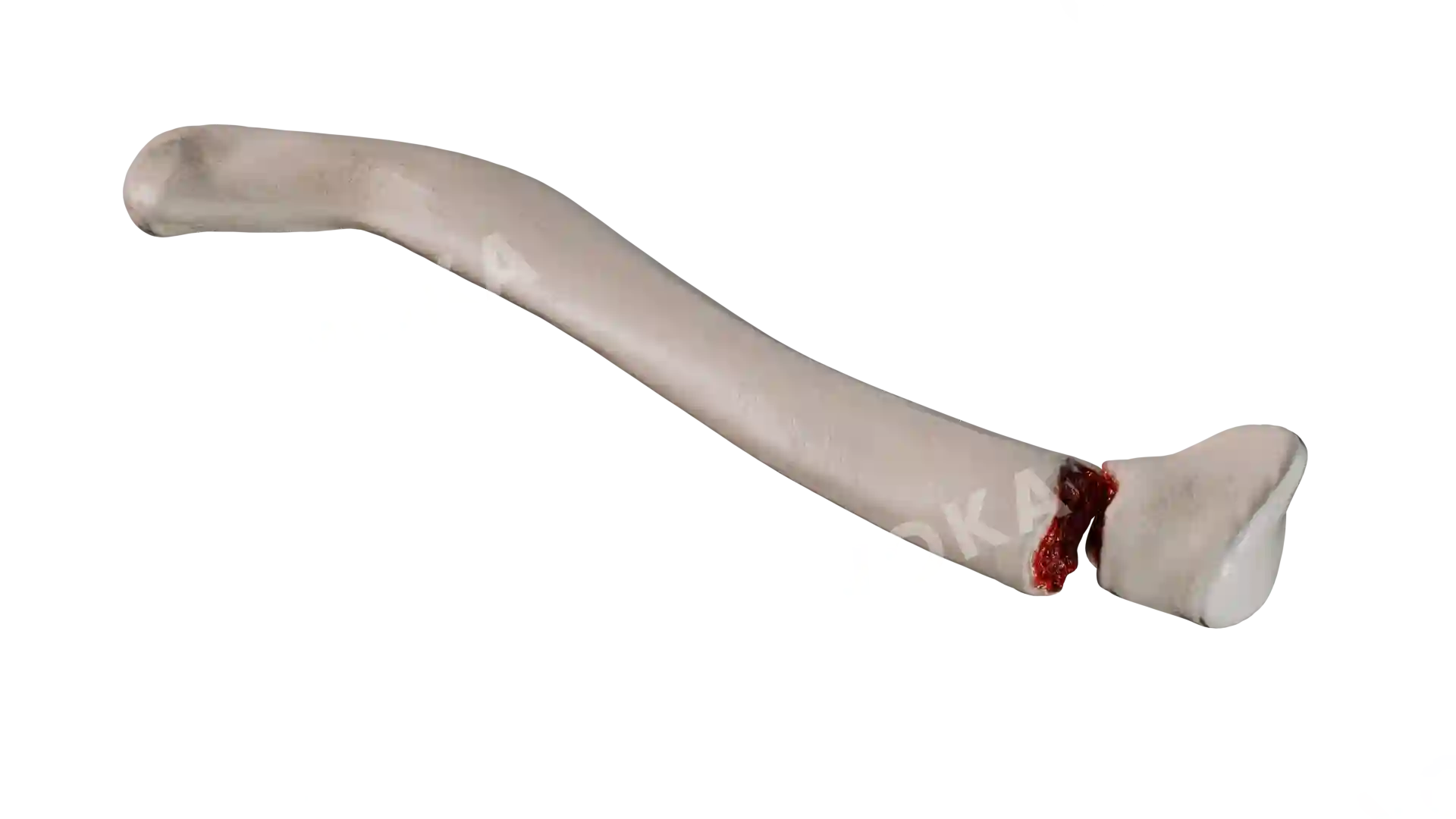 Clavicle type 1 HB1 1 2 trv image