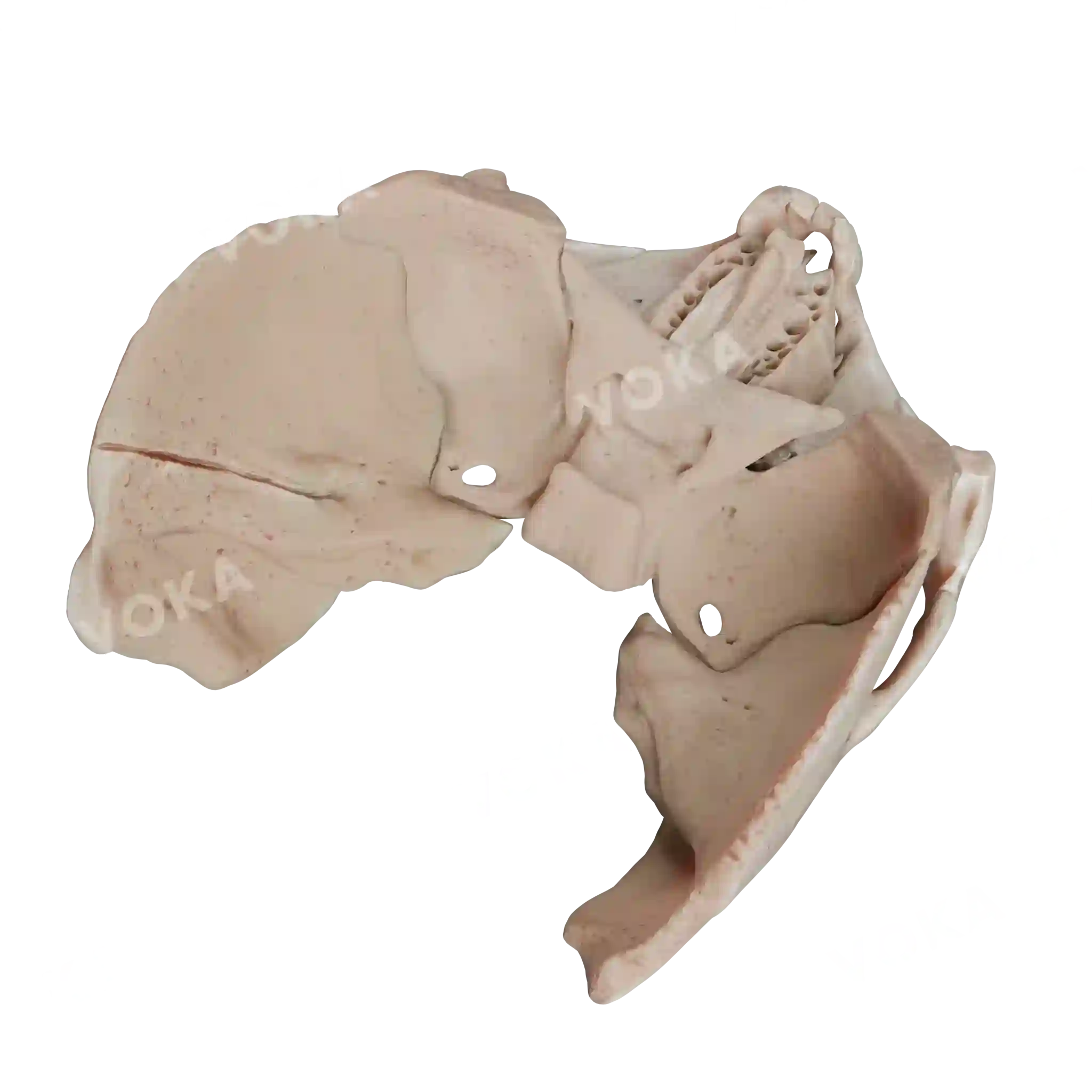 Fracture of the left temporal bone with extension to the petrous part image