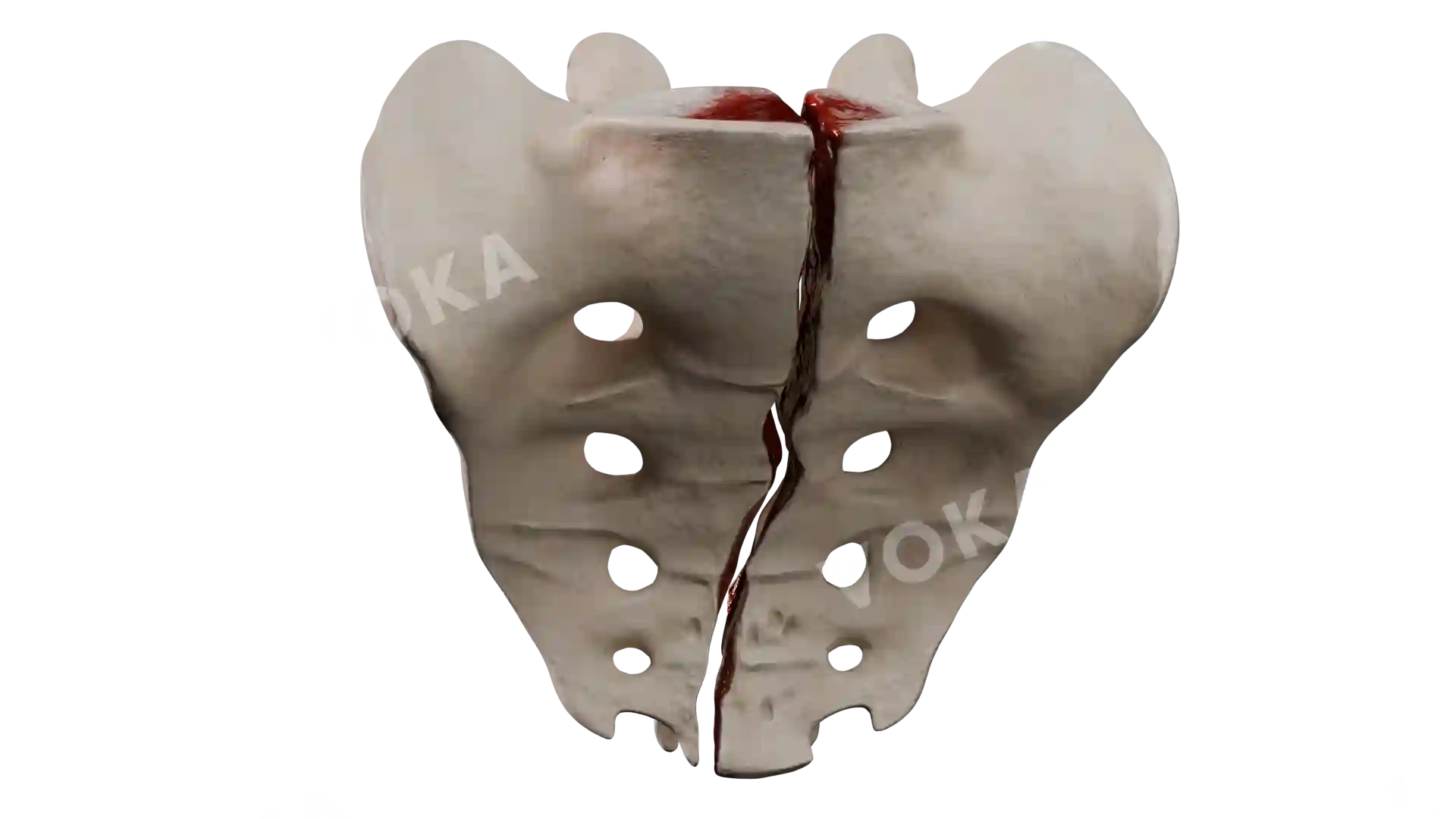 Sacrum coccyx type 3 BE3 1 3 trv image