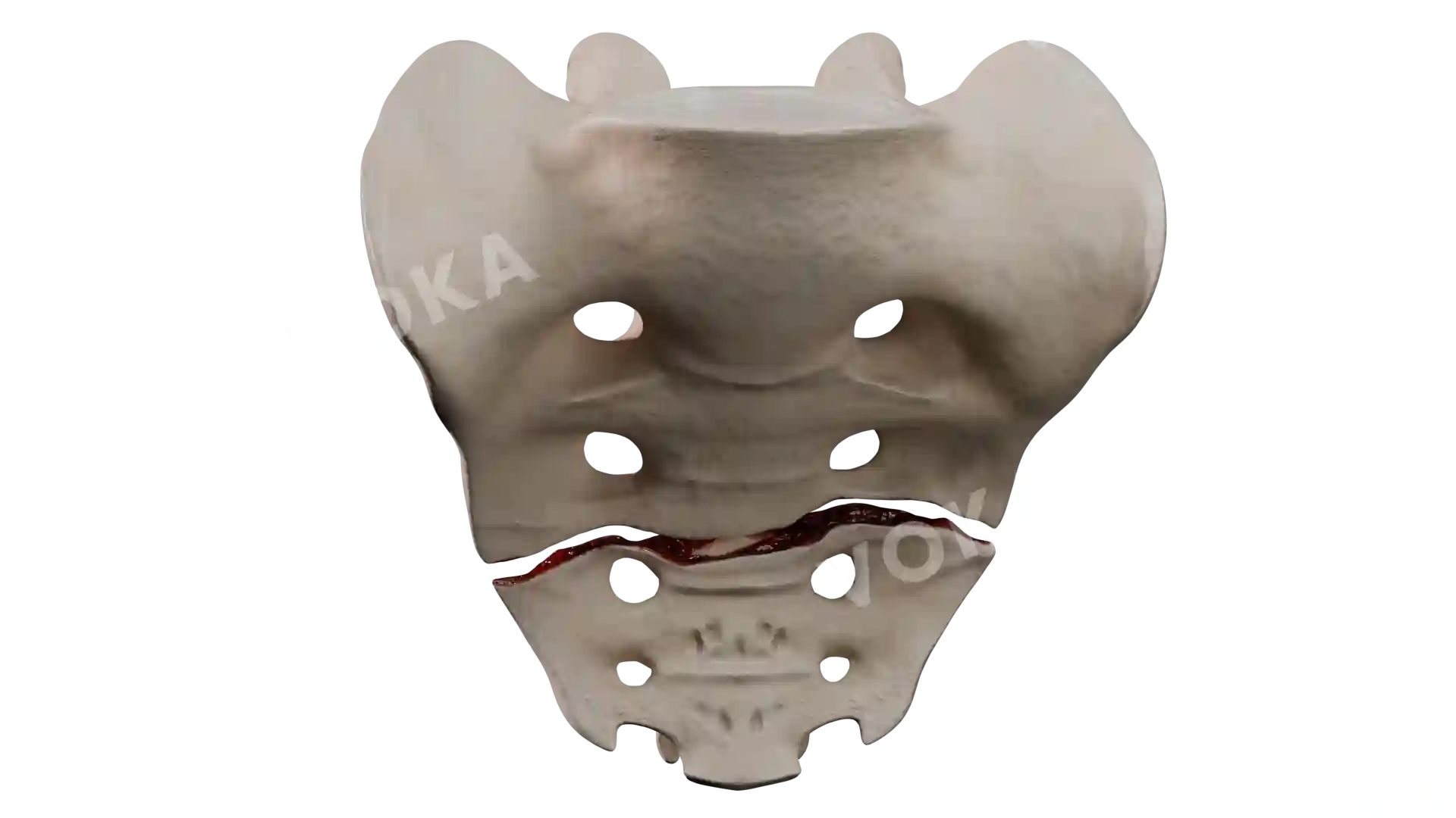 Sacrum coccyx type 4 BE4 1 trv image