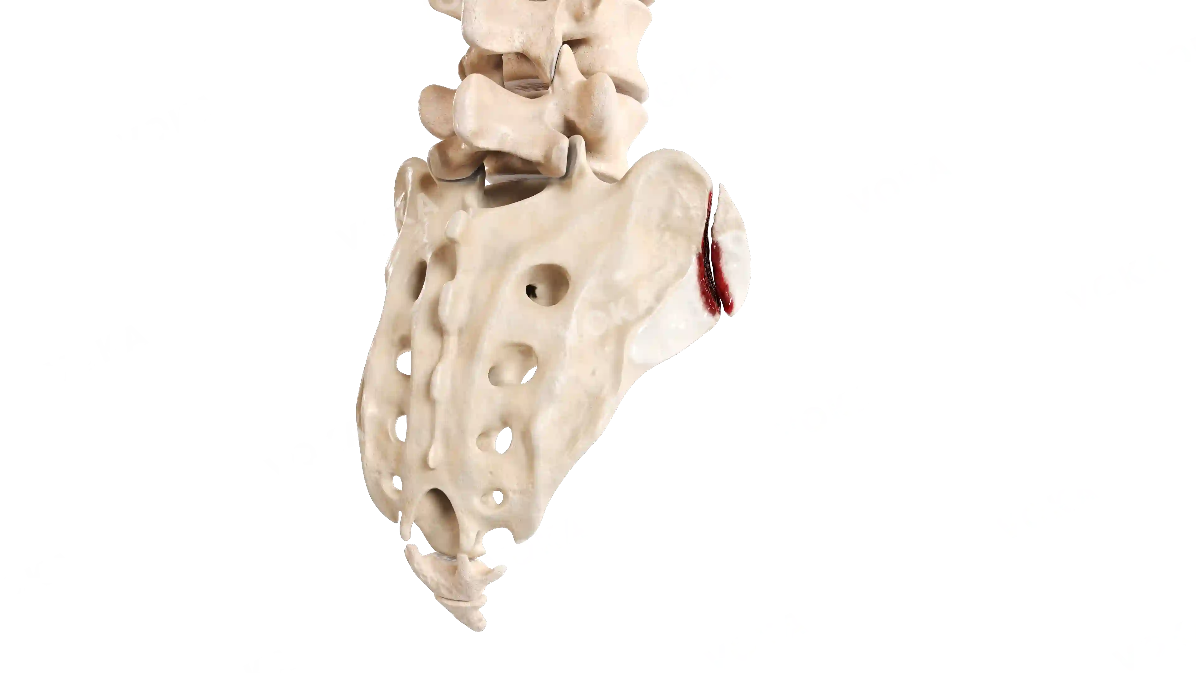 Sacrum fracture: zone 1 (Denis classification) image