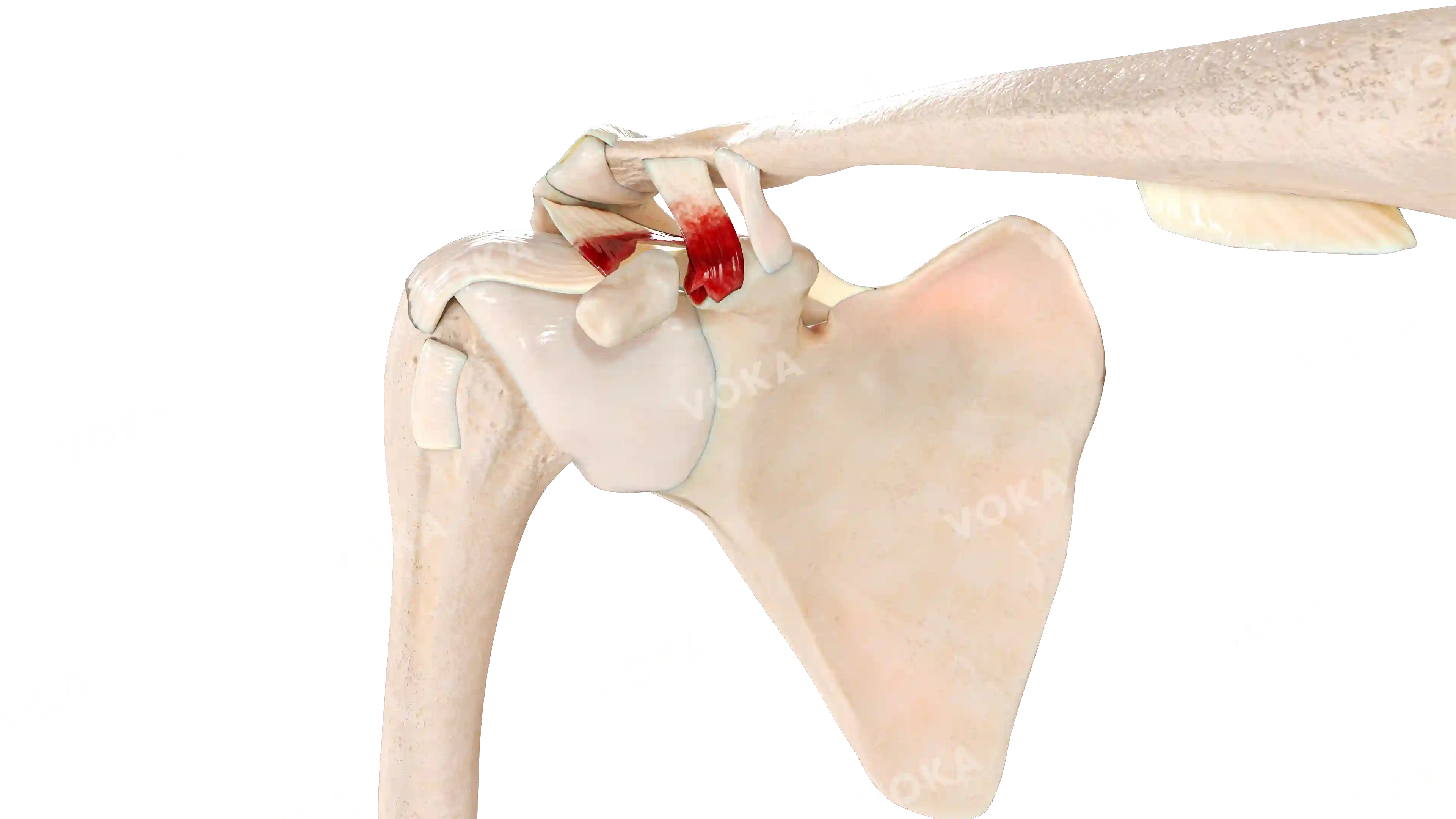Scapula coracoid process fracture Ogawa I and Eyres II image