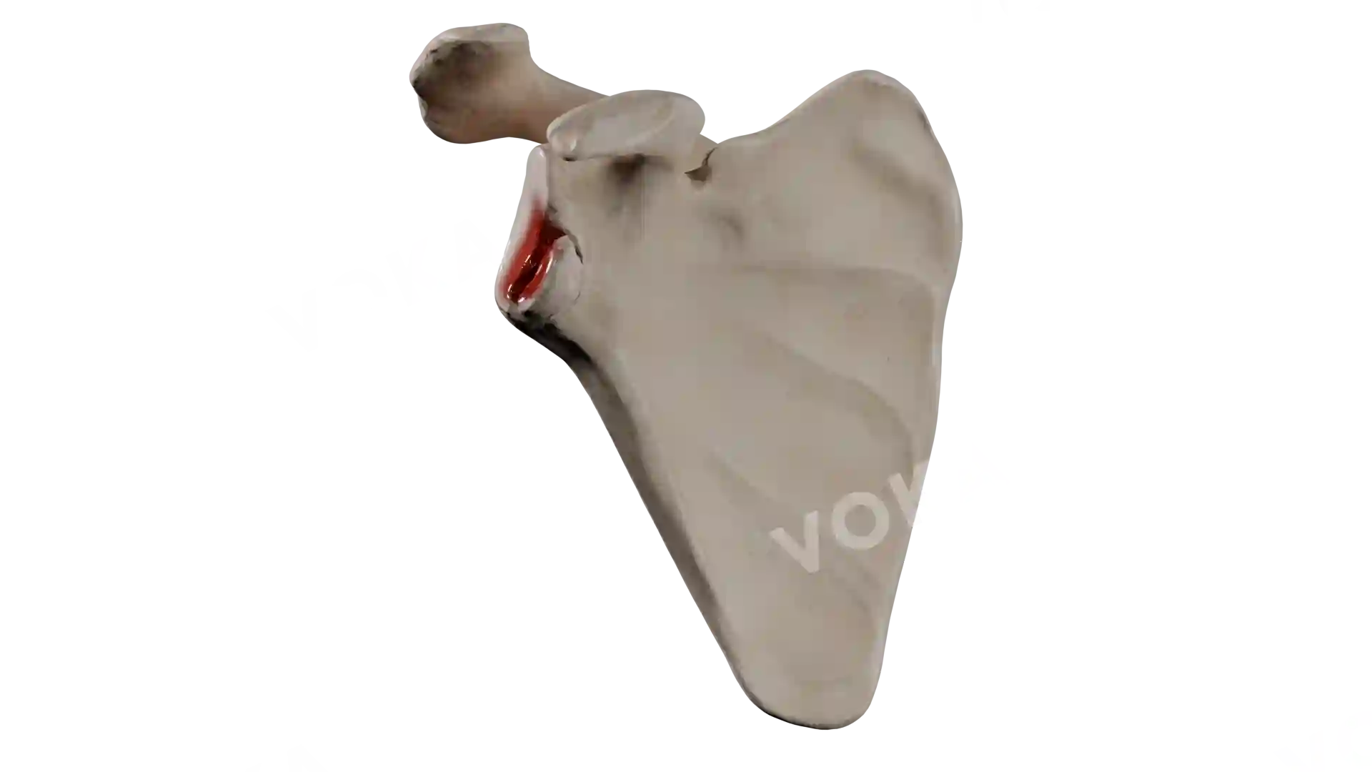 Scapula fraction type 2 HA2 1 1 trv image
